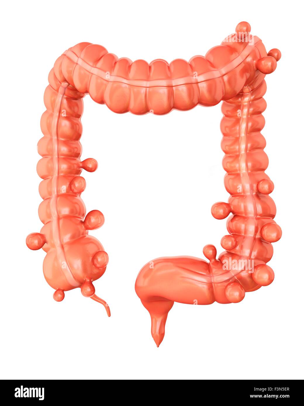 Diverticolosi, illustrazione Foto Stock