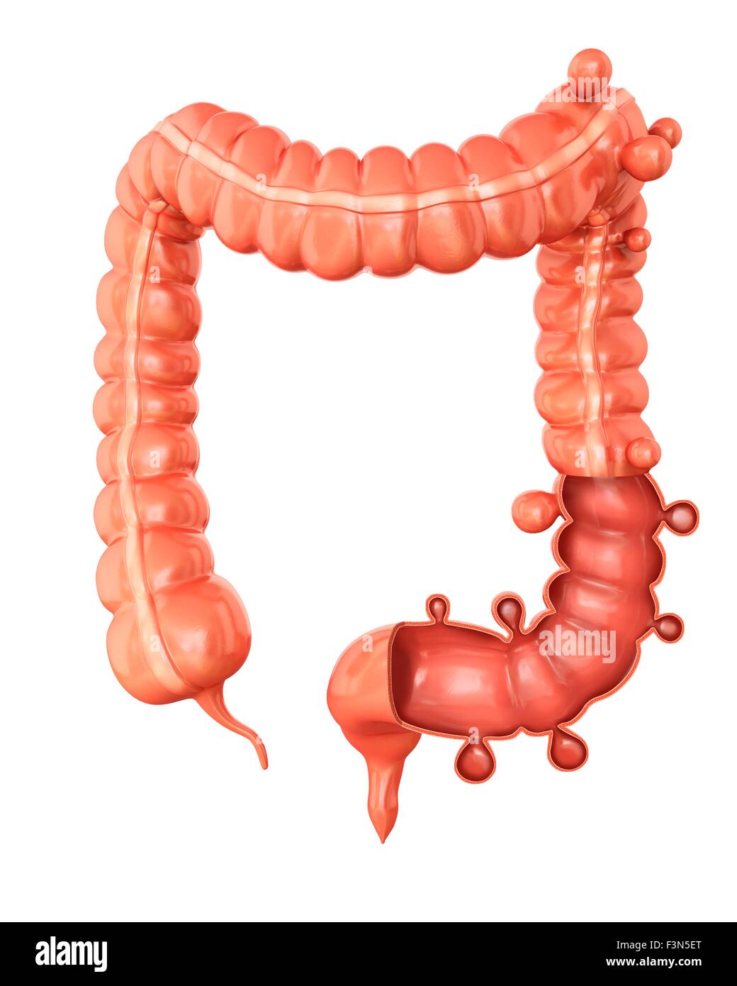 Diverticolosi, illustrazione Foto Stock