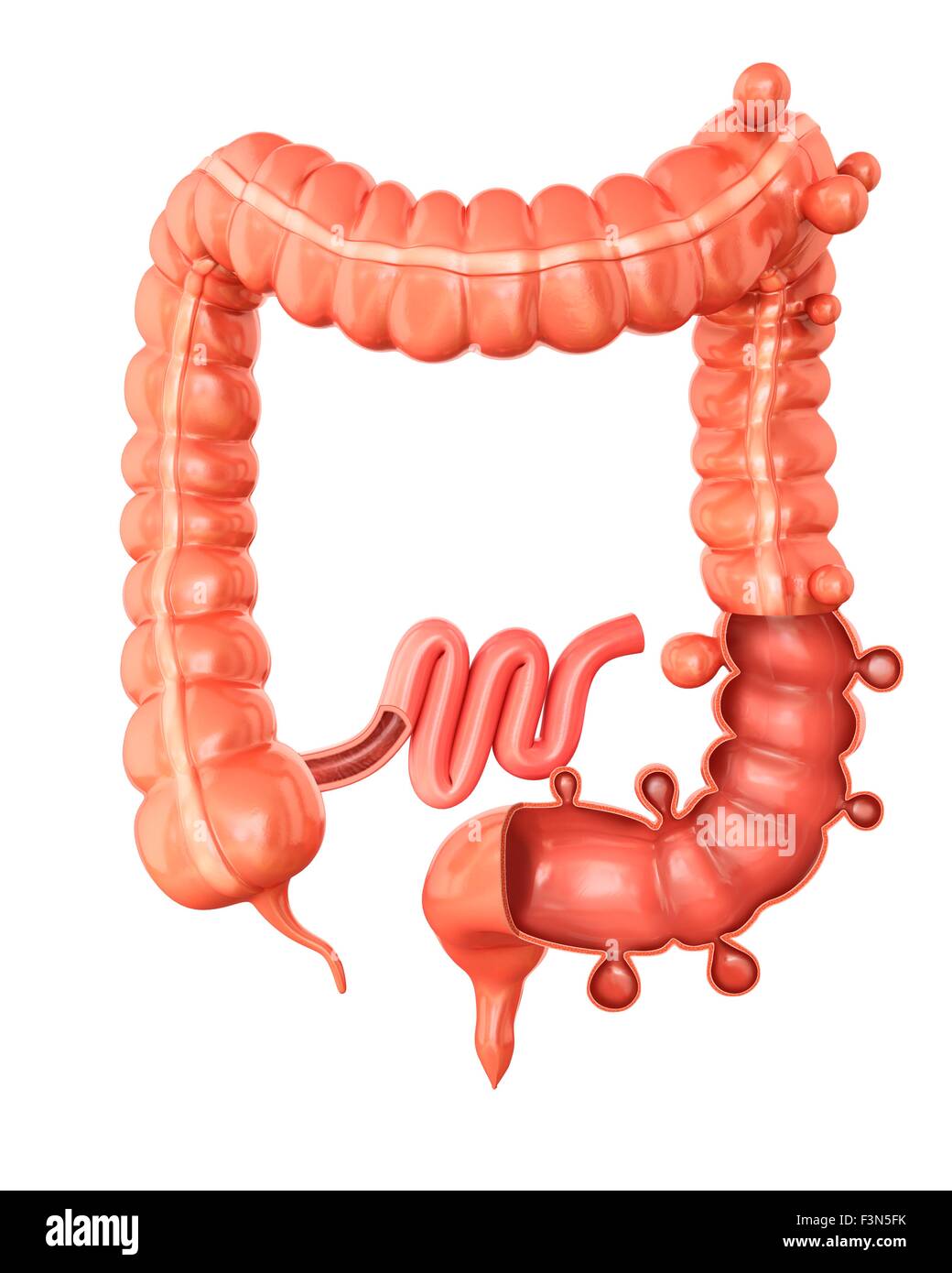 Diverticolosi, illustrazione Foto Stock