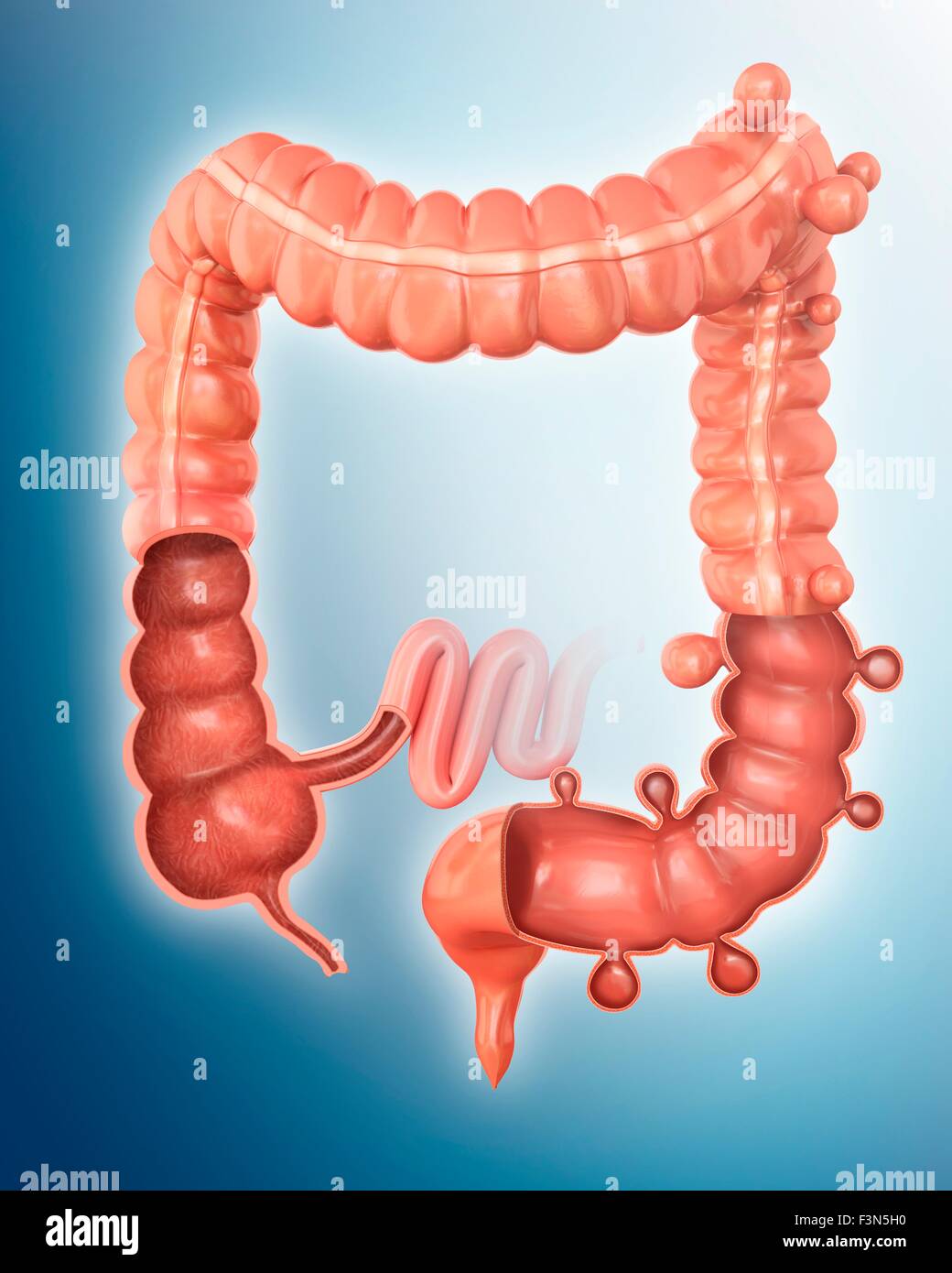 Diverticolosi, illustrazione Foto Stock