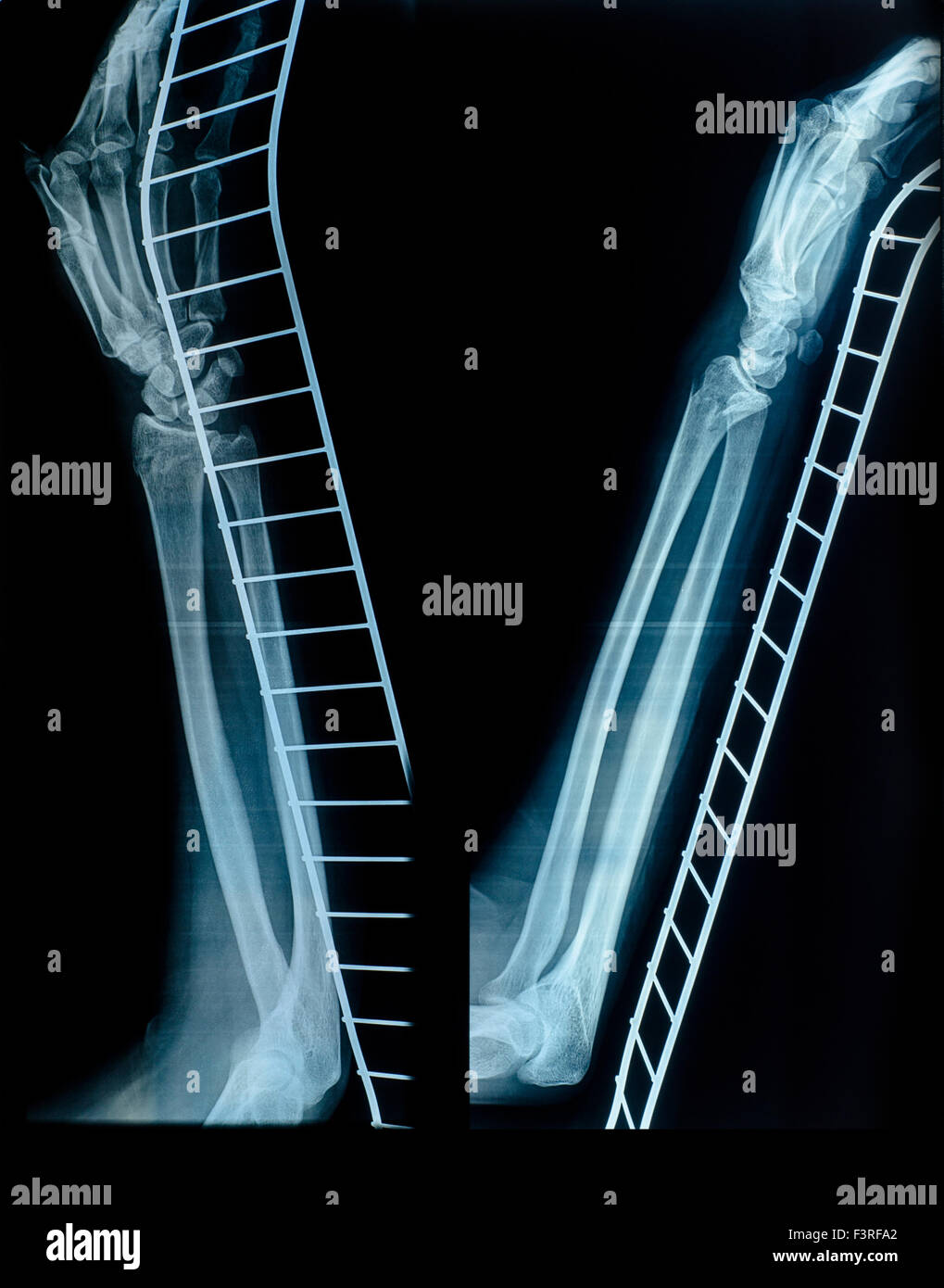 Immagine a raggi X della mano umana e braccio dopo una frattura sul supporto metallico. Visita medica Foto Stock