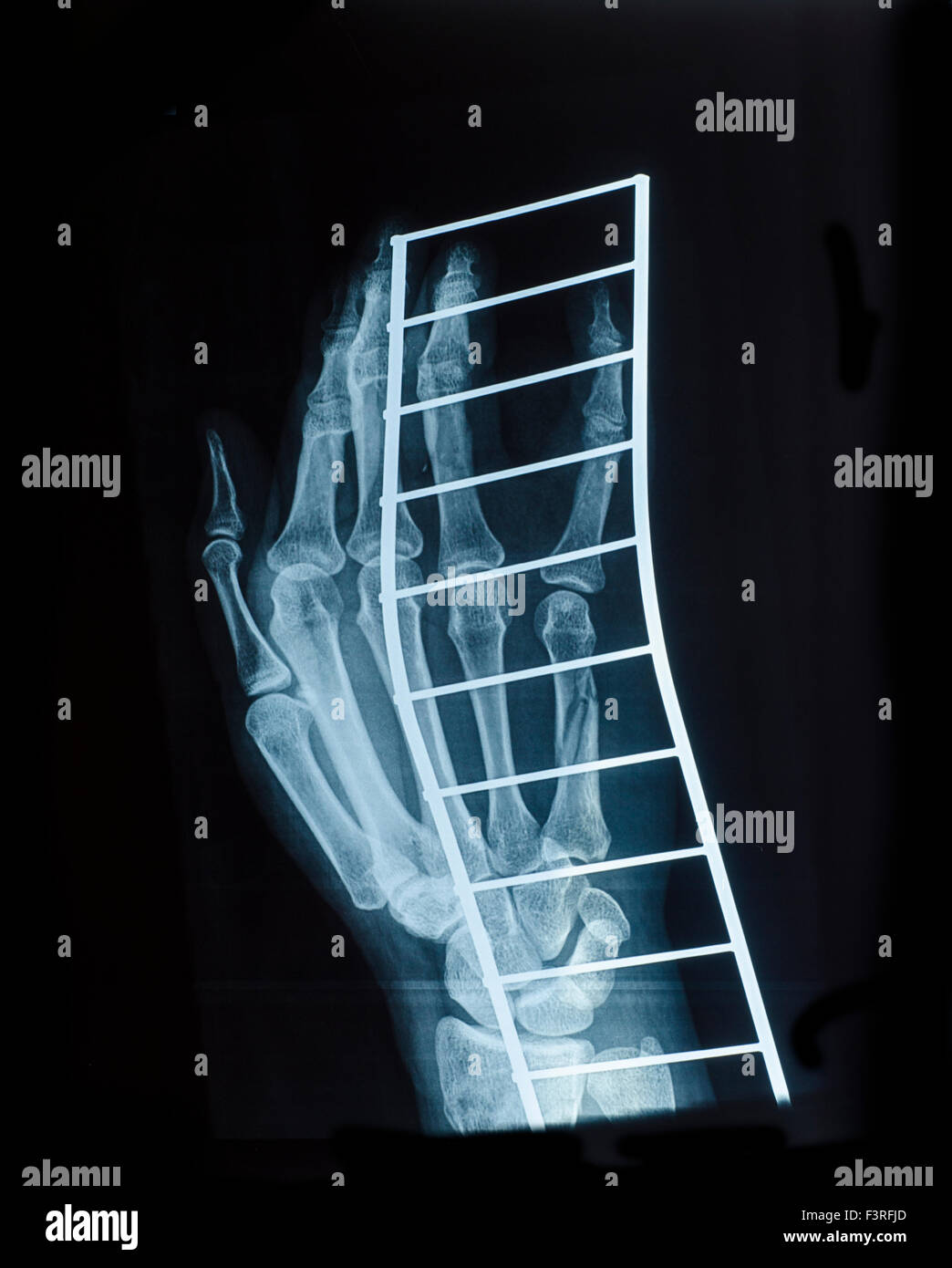 Immagine a raggi X della mano umana dopo una frattura sul supporto metallico. Visita medica Foto Stock