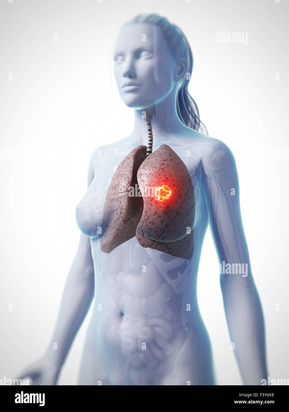 3d reso illustrazione del cancro ai polmoni Foto Stock