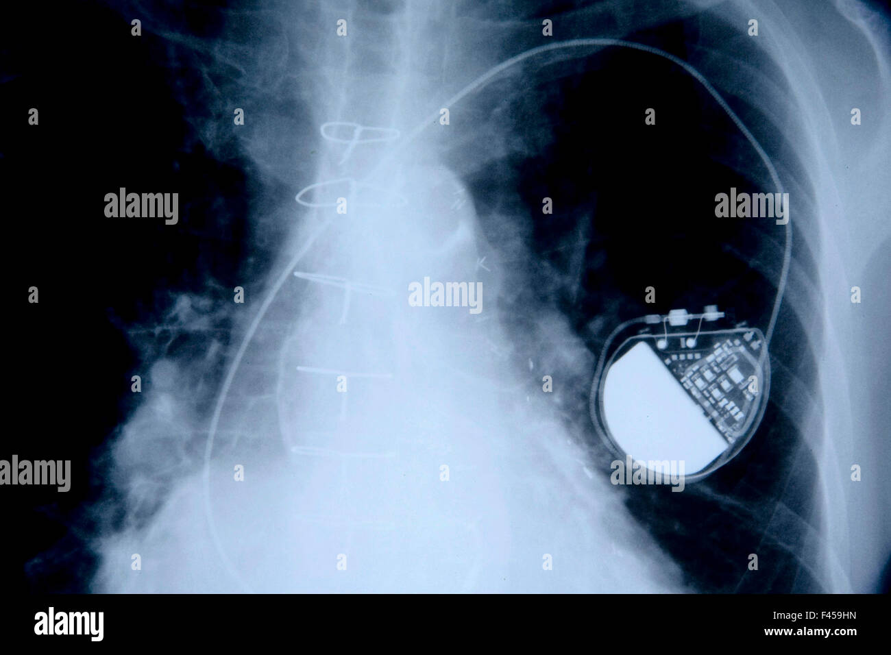 Una radiografia del torace di un 75-anno-vecchio uomo mostra un pacemaker in luogo. Nota la lunga 'elettrico piombo ". Il pacemaker è un dispositivo medico che utilizza gli impulsi elettrici, consegnati da elettrodi contraendo i muscoli del cuore, per regolare il battito del cuore. Foto Stock