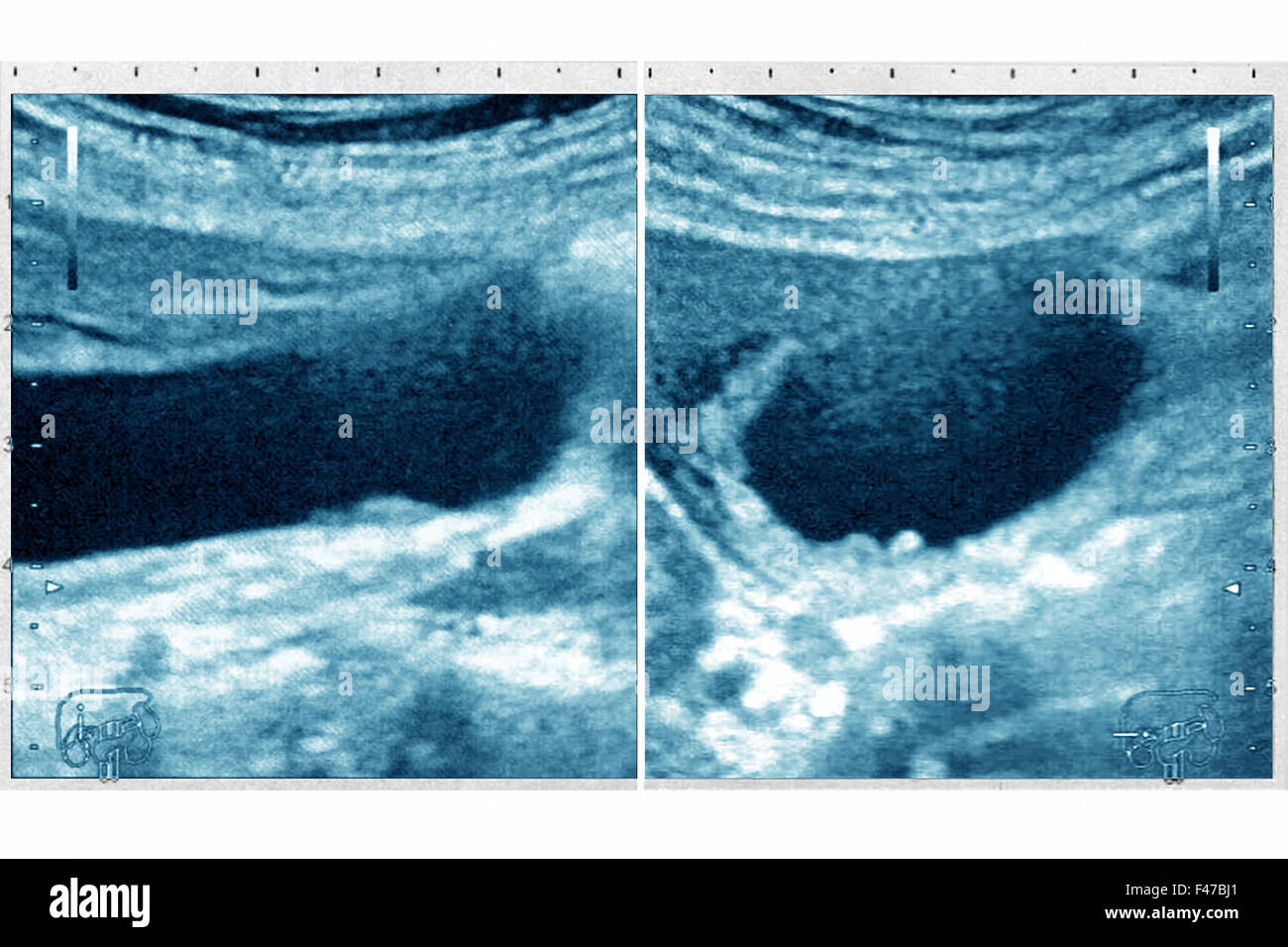 Ultrasuoni colecistite Foto Stock