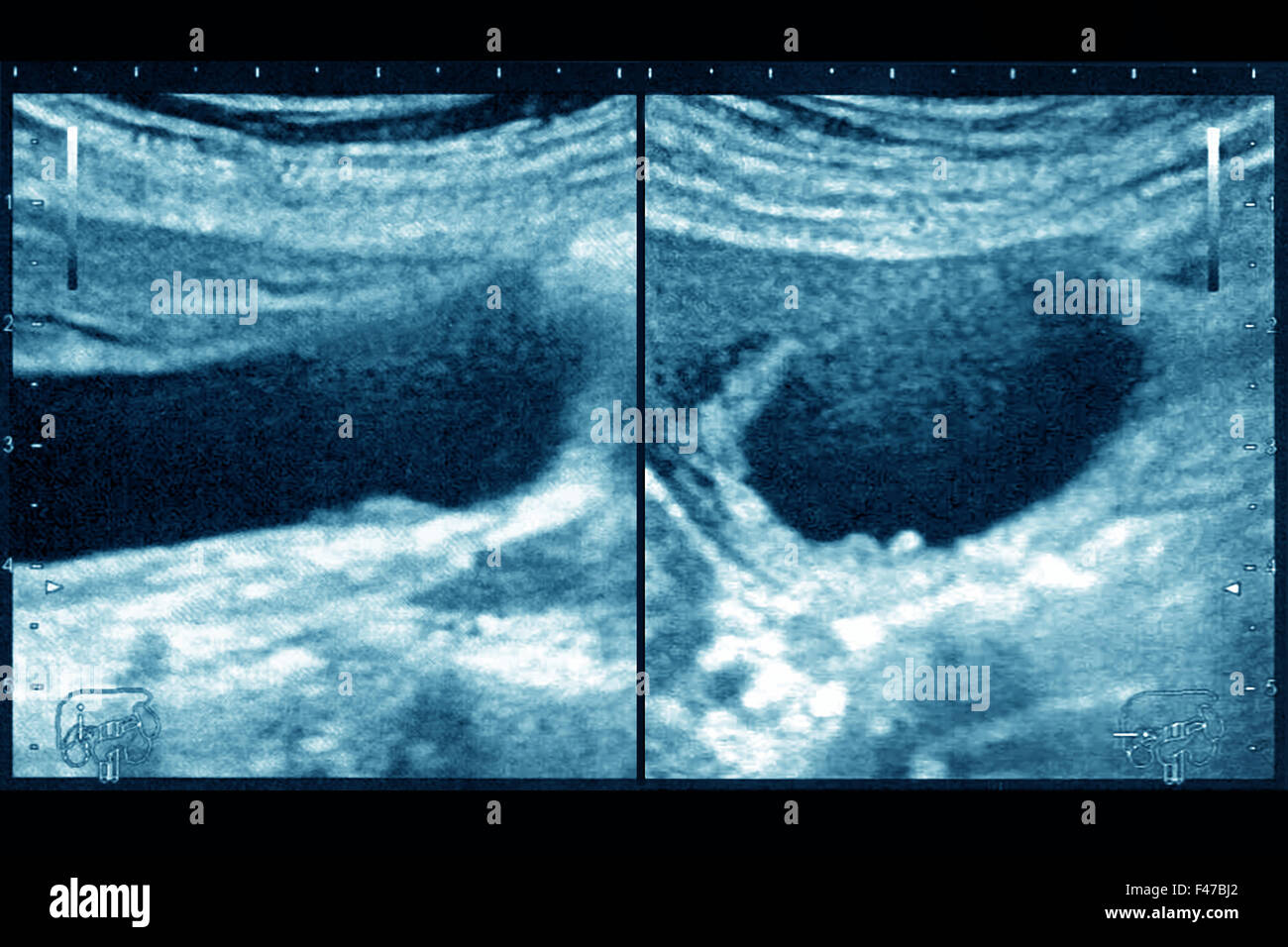 Ultrasuoni colecistite Foto Stock