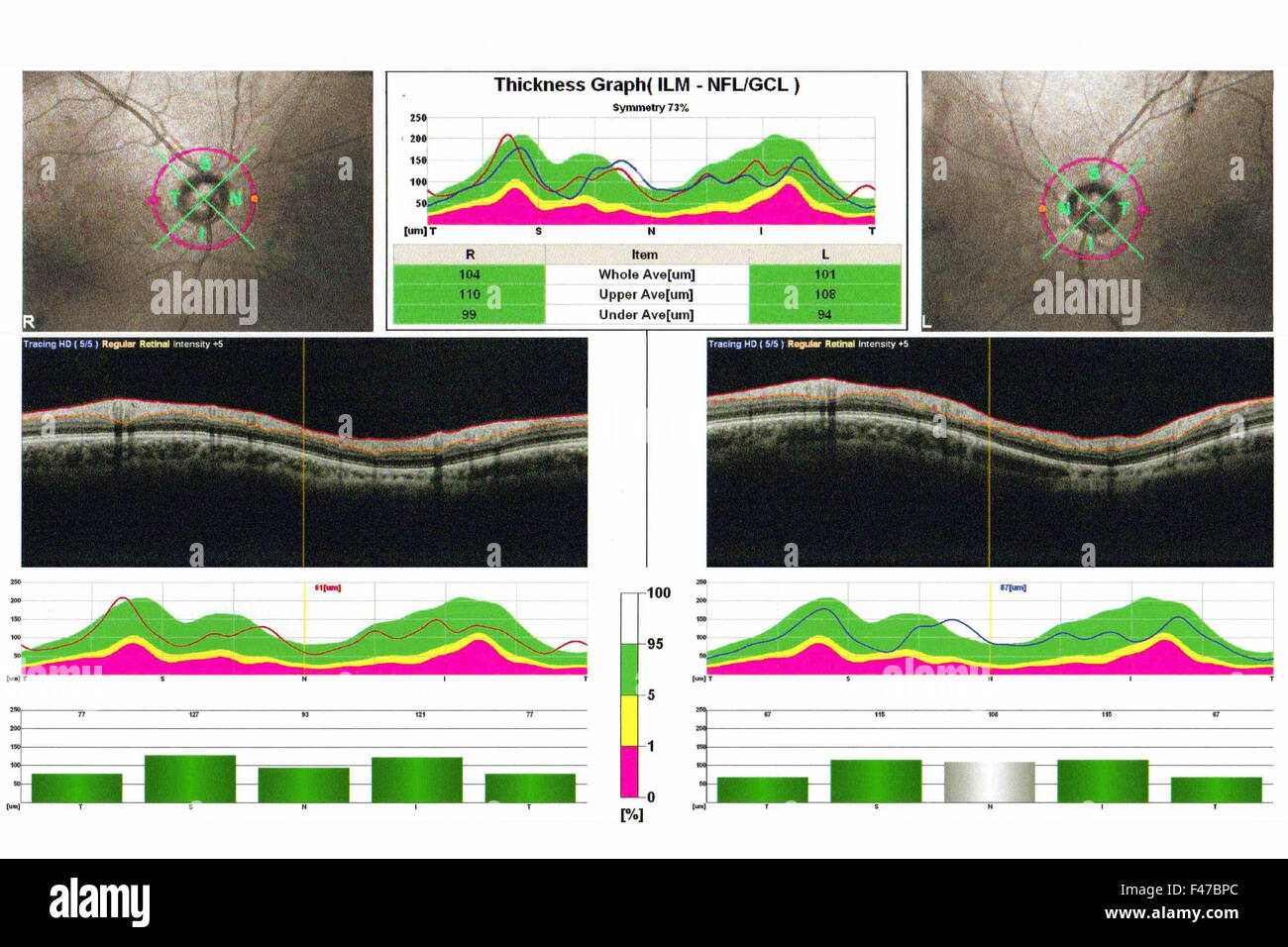 Tomografia a coerenza ottica immagini e fotografie stock ad alta