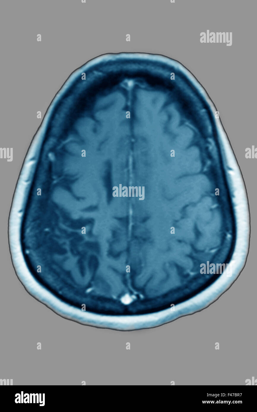 Atrofia cerebrale, MRI Foto Stock