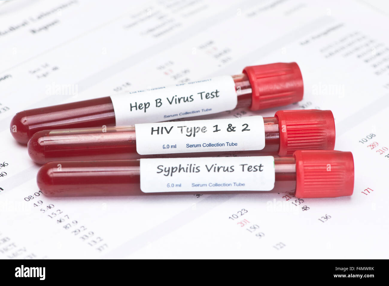 Esami del sangue per 3 malattie sessualmente trasmesse sulla relazione di laboratorio. Foto Stock