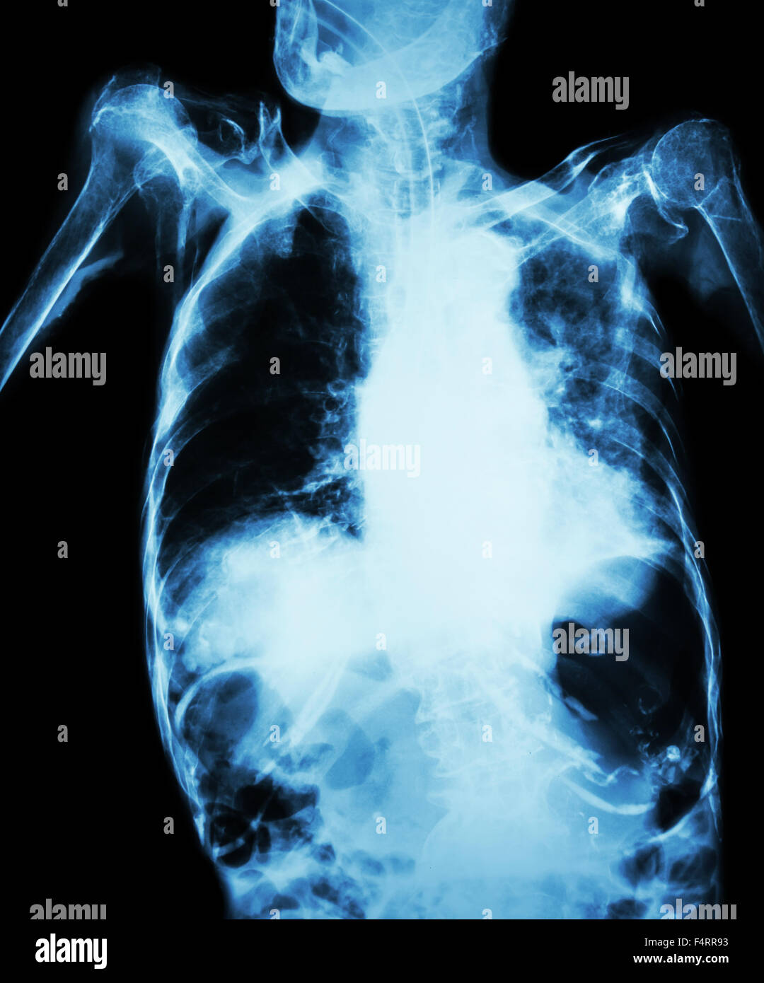 La tubercolosi polmonare con insufficienza respiratoria acuta ( pellicola i raggi x al torace del paziente vecchio show e alveolari infiltrat interstiziale Foto Stock