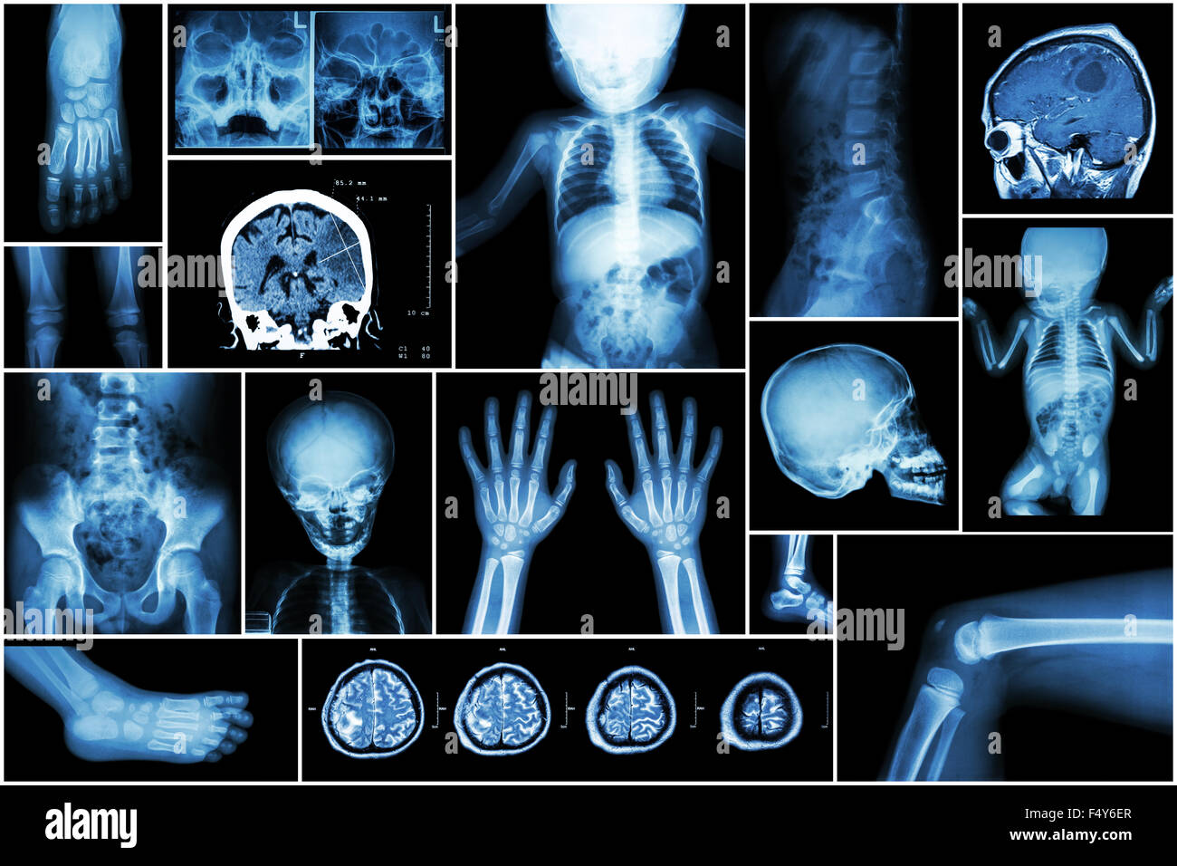 X-ray più parte del bambino 's body & più malattia ( corsa , tumore al cervello , artrite reumatoide , sinusite , gouty arthri Foto Stock