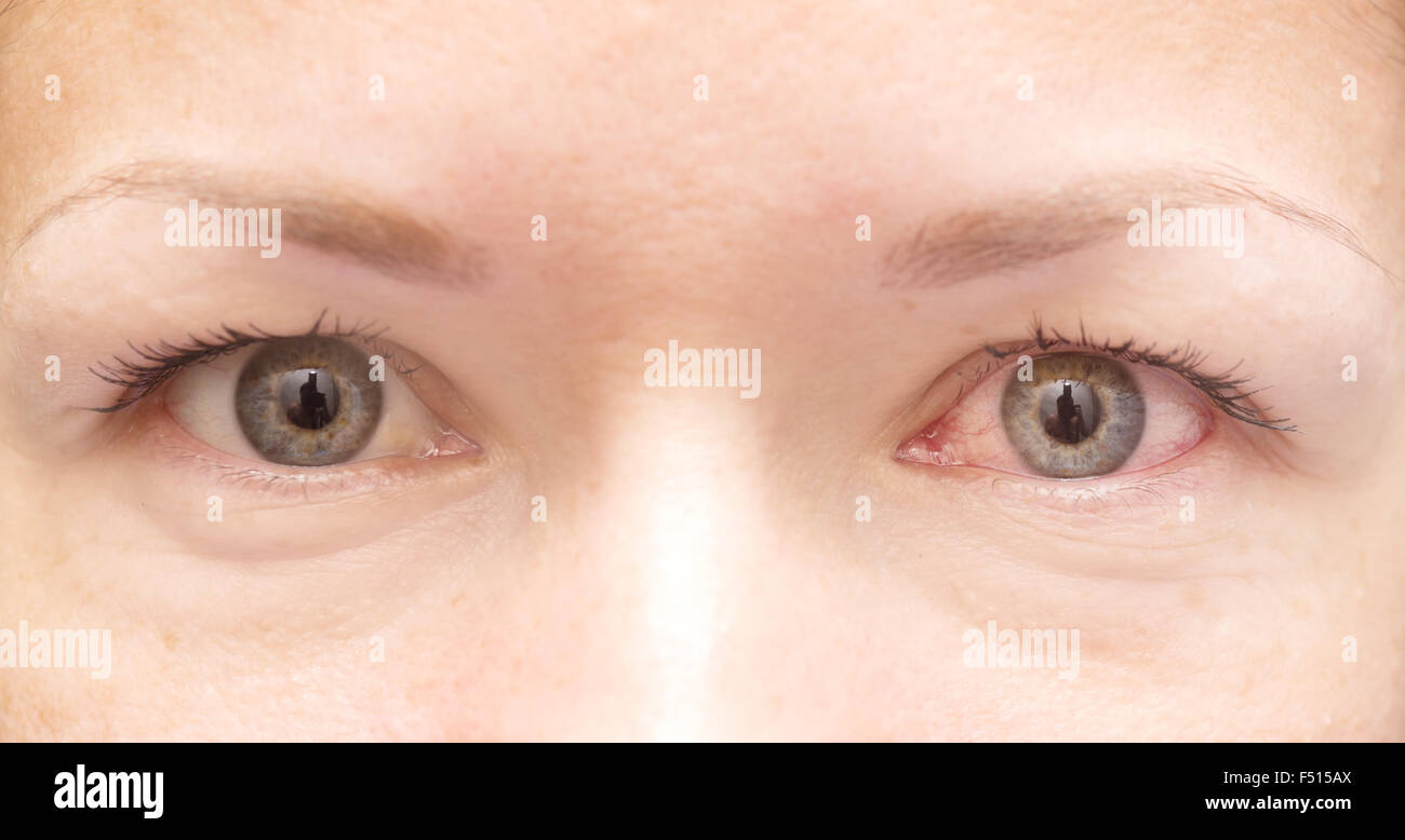 Close up di sano e irritata occhi rossi Foto Stock