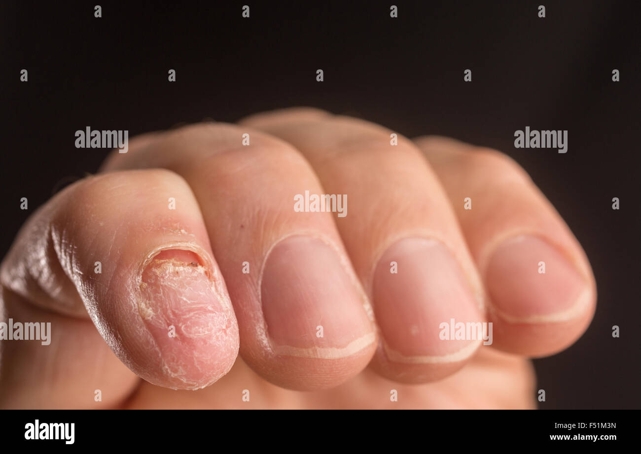 Un maschio adulto mano con un'unghia mancante Foto Stock