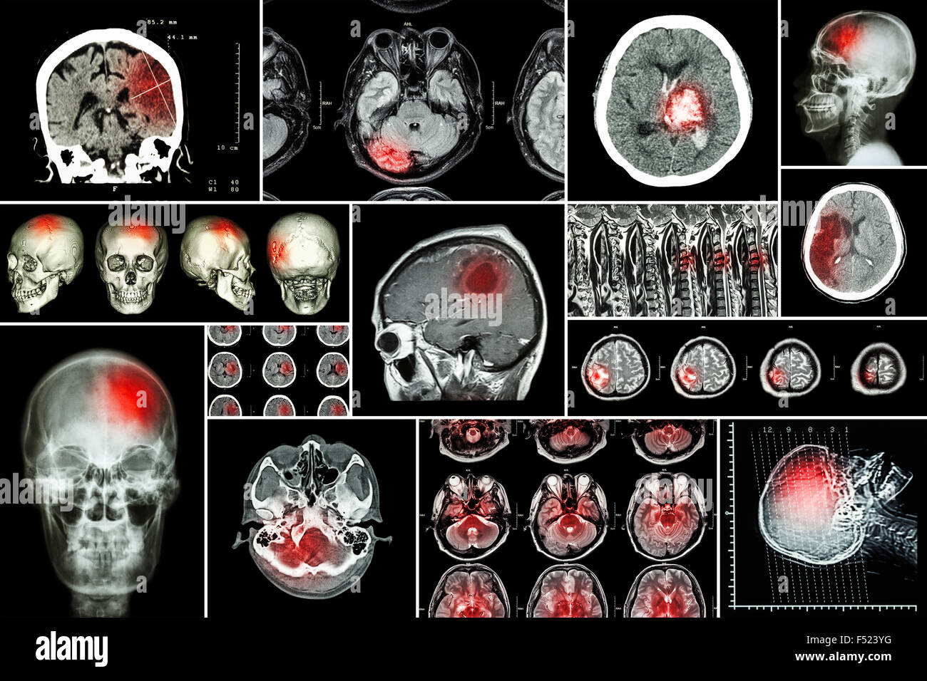 Set , raccolta di malattia del cervello ( infarto cerebrale , Ictus emorragico , tumore al cervello , l'ernia discale con midollo spinale co Foto Stock