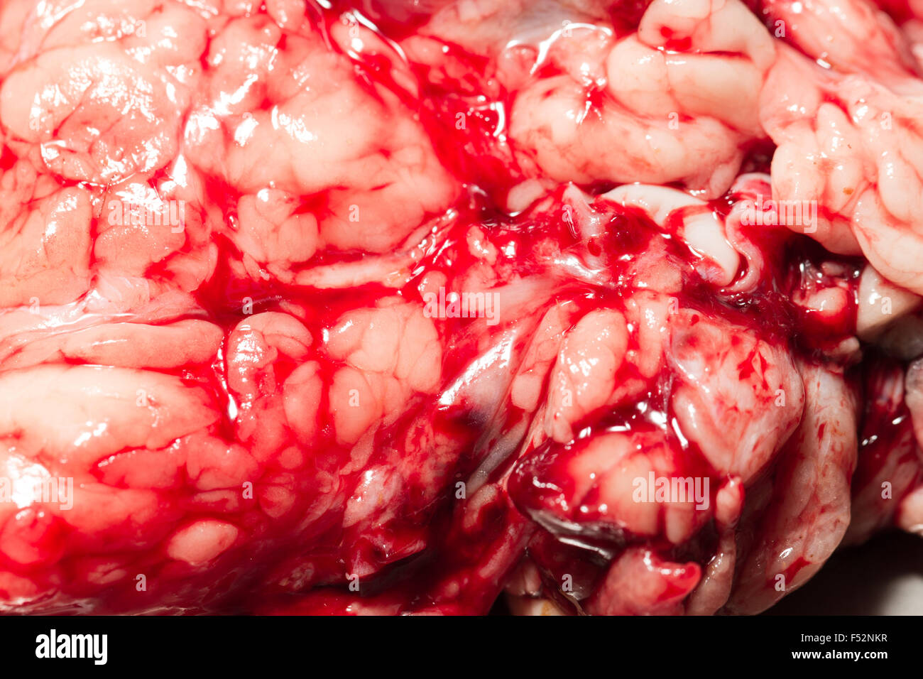 Una vista dettagliata del tessuto cerebrale grezzo, che mostra la superficie contorta della corteccia cerebrale. Il tessuto è umido e luccicante, con un raggruppamento di sangue rosso visibile e infiltrazione tra le pieghe Foto Stock