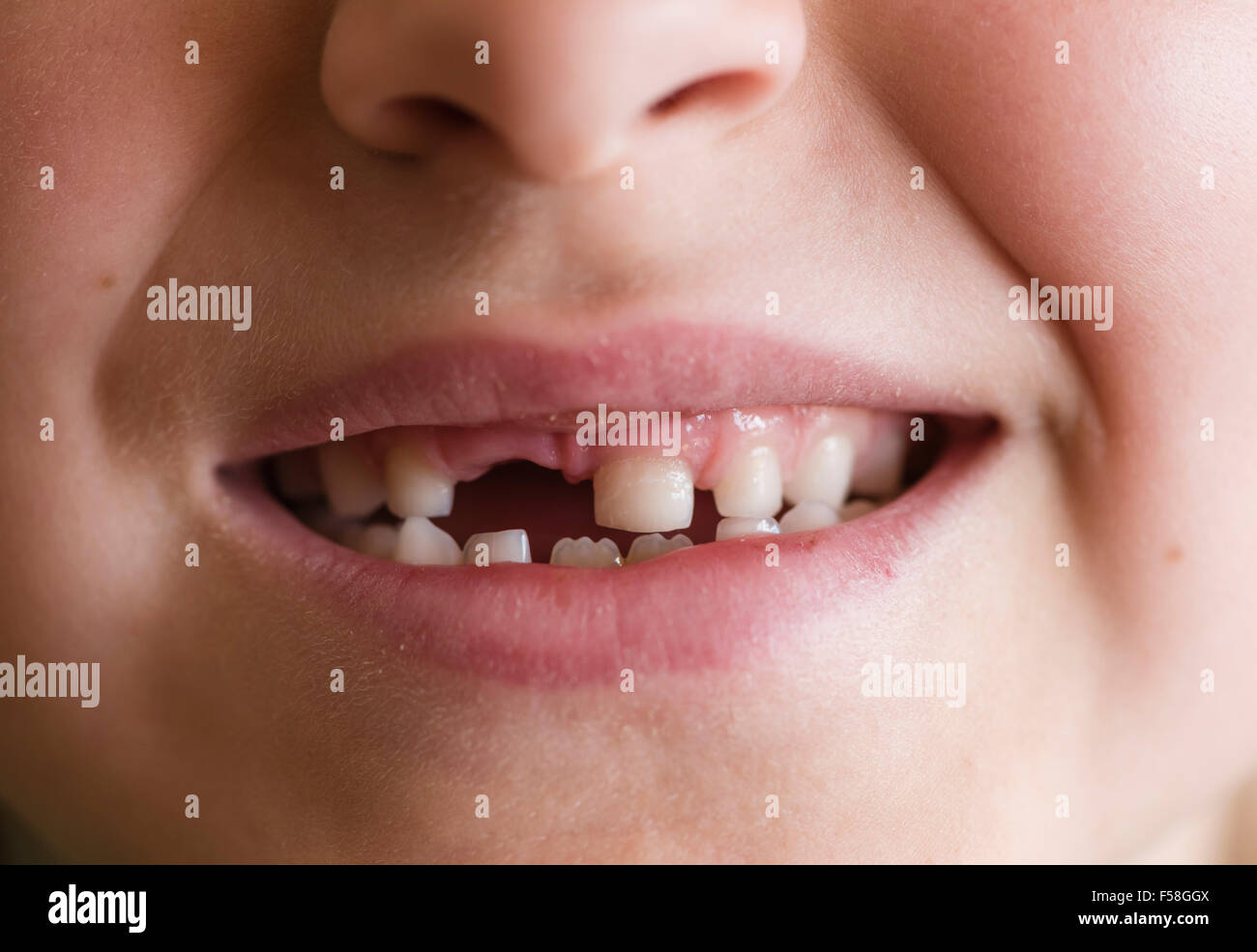 Gap-dentata dentizione primaria di un 7 anno di old boy Foto Stock