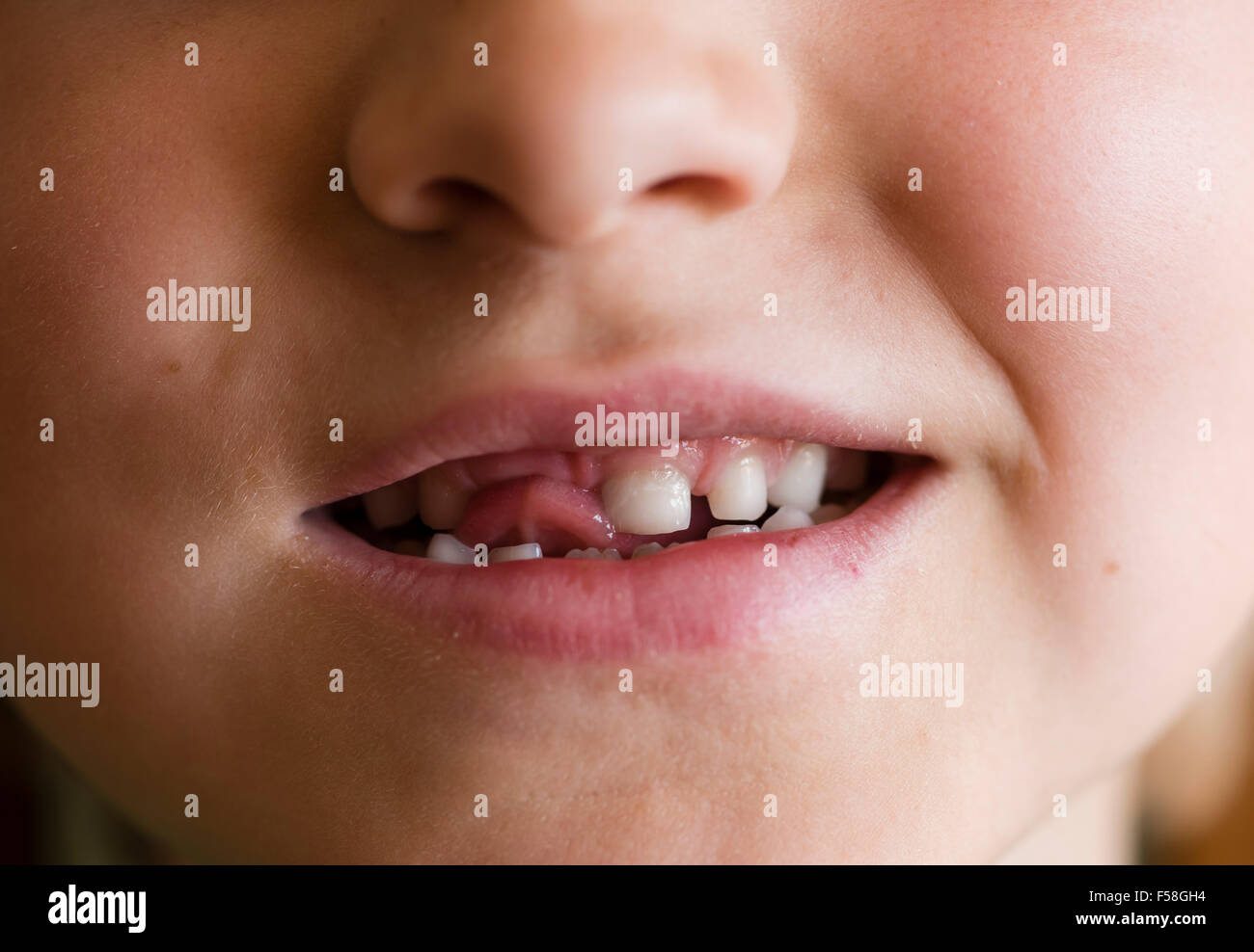 Gap-dentata dentizione primaria di un 7 anno di old boy Foto Stock