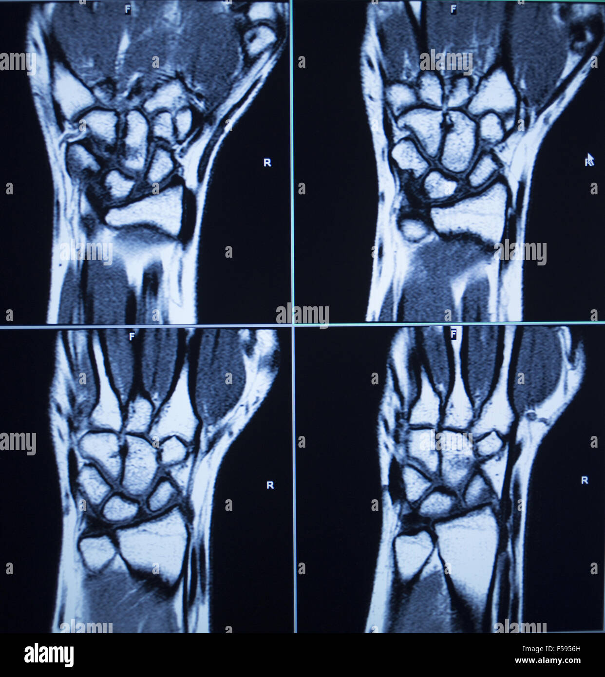 MRI magentic di immagini a risonanza magnetica nucleare scansione scansione  i risultati dei test dei polsi mani foto di pregiudizio Foto stock - Alamy