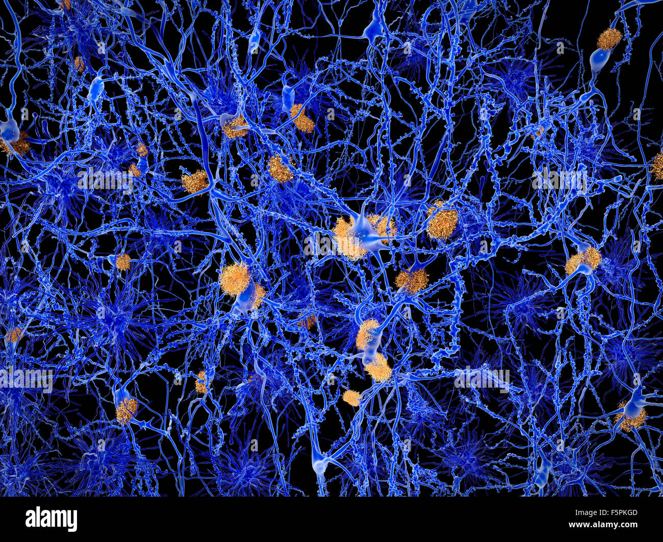 Il morbo di Alzheimer. Computer illustrazione delle placche amiloidi tra neuroni. Placche amiloidi sono caratteristiche di Foto Stock