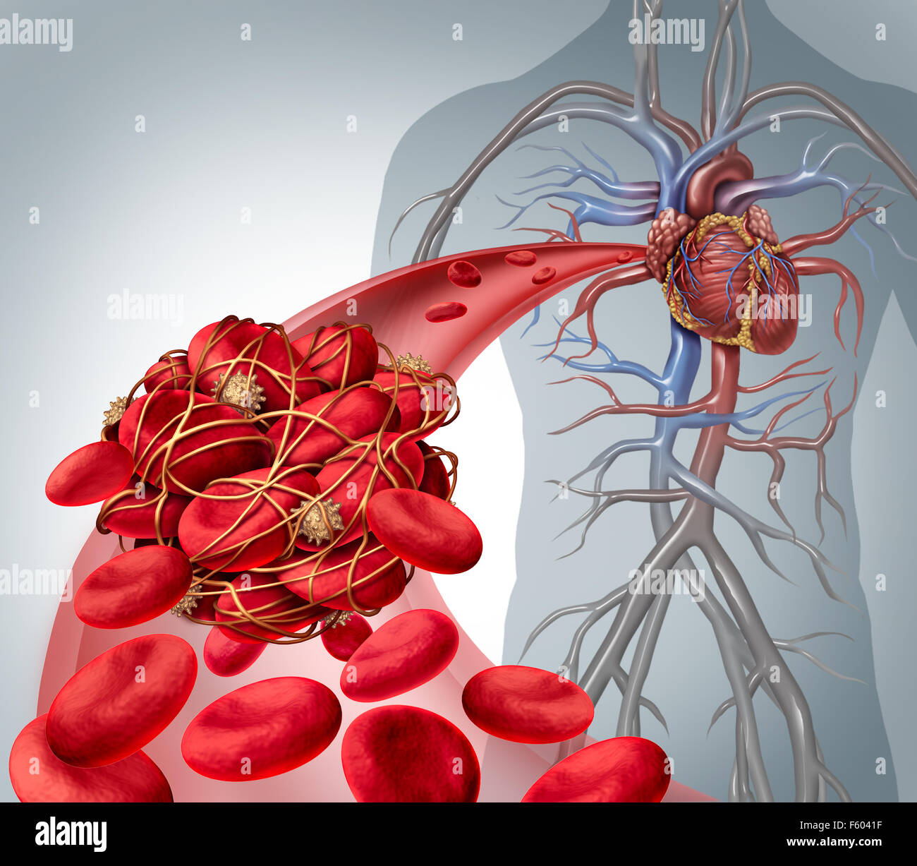 Di coagulo di sangue e rischio di coagulo o trombosi Illustrazione medica come simbolo di un gruppo di cellule del sangue umano ammassate insieme da sticky piastrine e fibrina la creazione di un blocco in una arteria o vena che conducono al cuore. Foto Stock