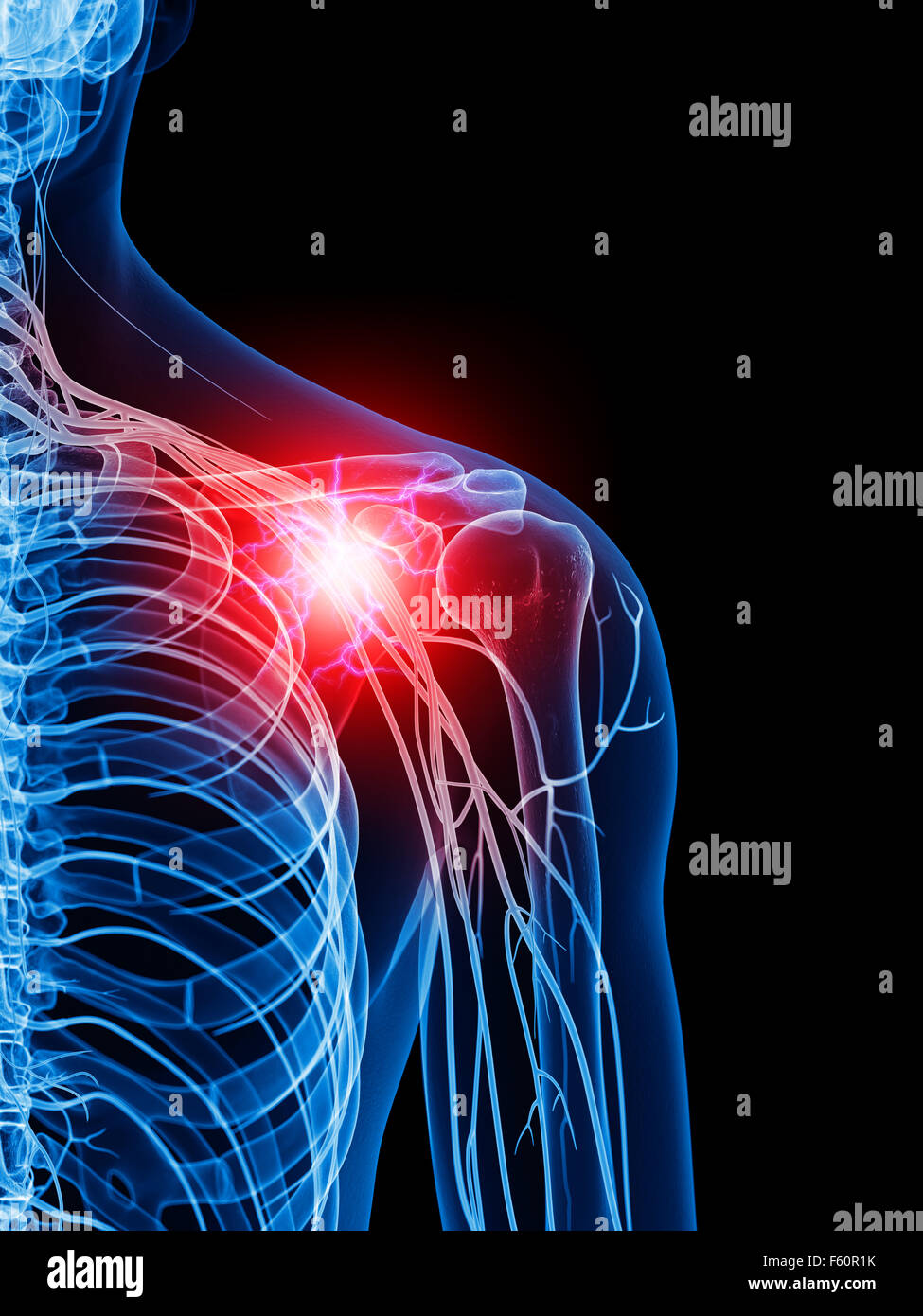 Dal punto di vista medico illustrazione accurata di una spalla dolorosa Foto Stock