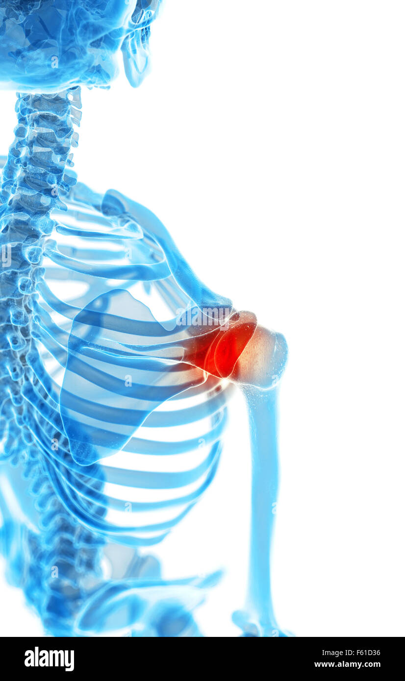 Dal punto di vista medico illustrazione accurata - spalla dolorosa Foto Stock
