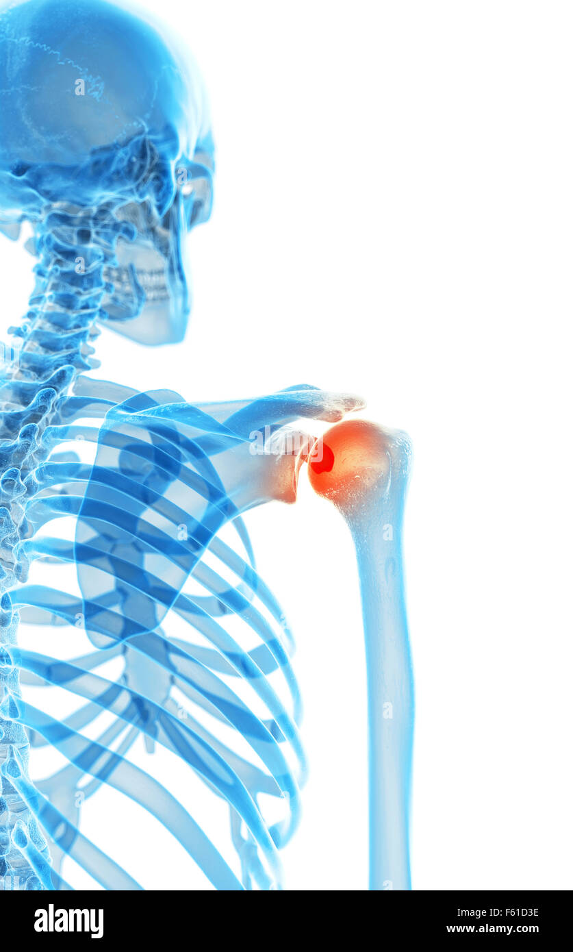 Dal punto di vista medico illustrazione accurata - spalla dolorosa Foto Stock