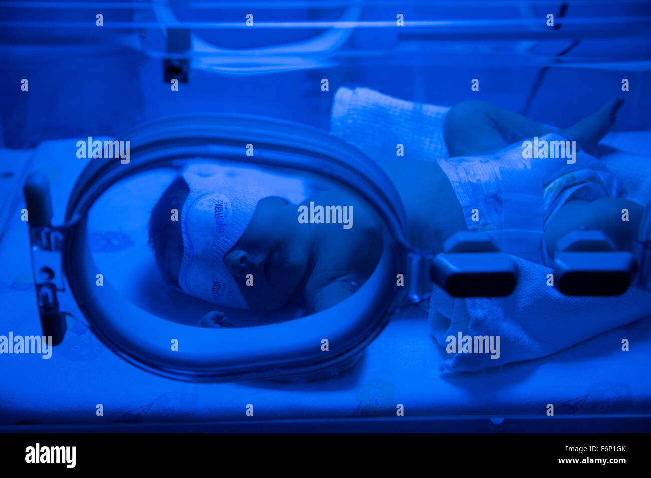 Neonato aventi raggi UVB trattamento di fototerapia per ittero in ospedale Foto Stock