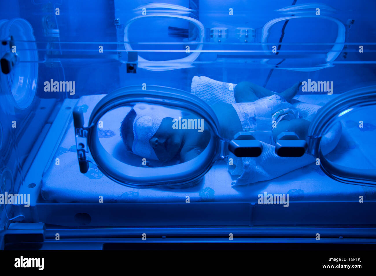 Neonato aventi raggi UVB trattamento di fototerapia per ittero in ospedale Foto Stock