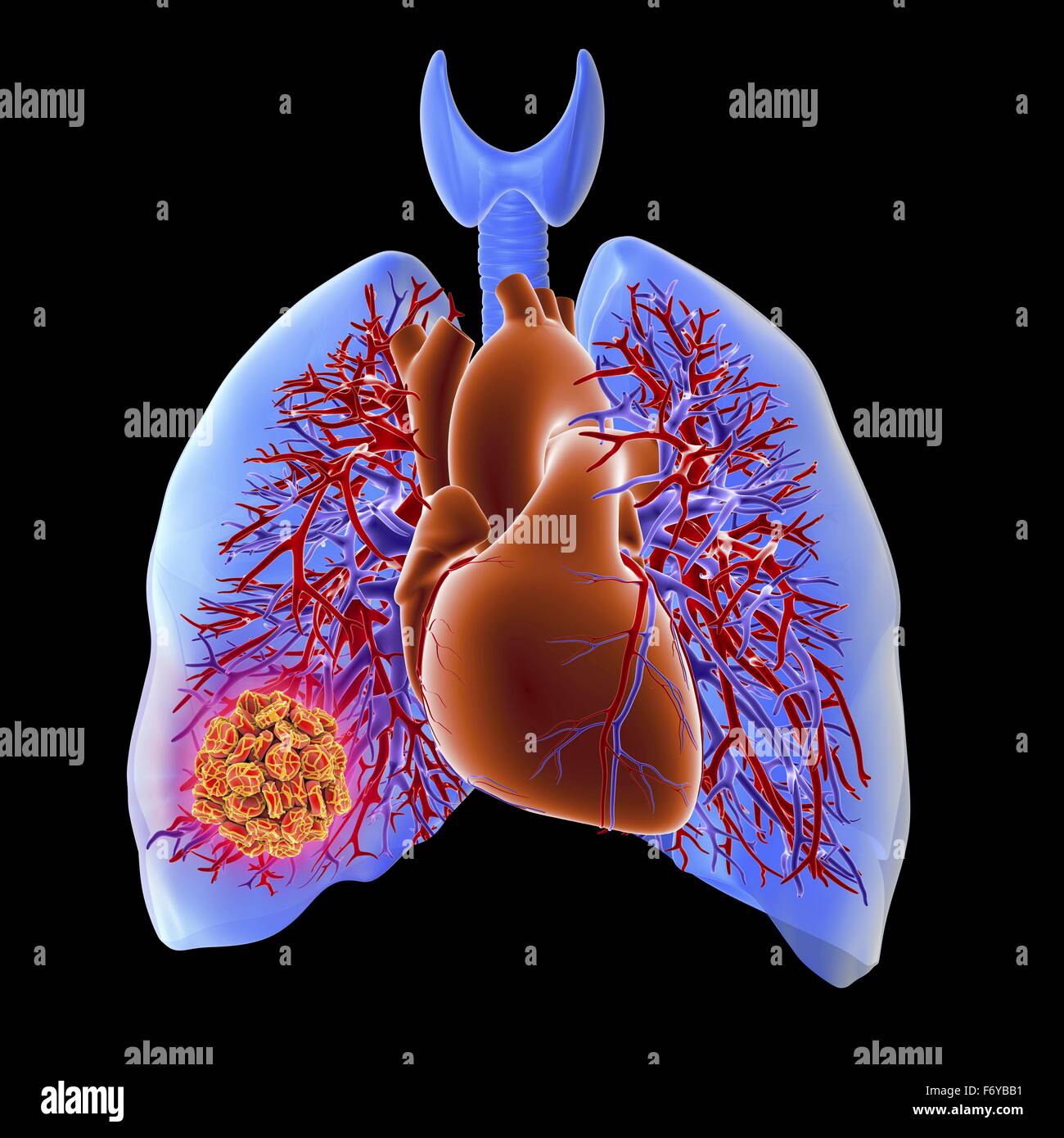 Il sistema circolatorio del cuore e dei polmoni, computer grafica, mostrando un trombo nel polmone destro. Questo si verifica quando una delle arterie polmonari è bloccato, solitamente da un anomalo di coagulo di sangue, che hanno interrotto la parete di una vena della gamba o bacino dopo Foto Stock