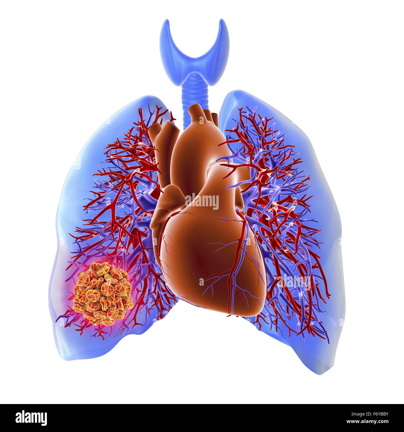 Il sistema circolatorio del cuore e dei polmoni, computer grafica, mostrando un trombo nel polmone destro. Questo si verifica quando una delle arterie polmonari è bloccato, solitamente da un anomalo di coagulo di sangue, che hanno interrotto la parete di una vena della gamba o bacino dopo Foto Stock