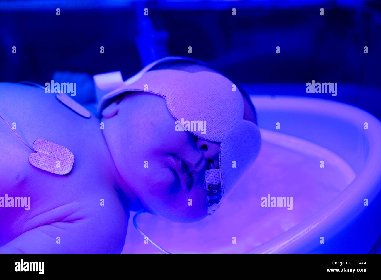 Un bambino prematuro è trattata con luce ultravioletta in un incubatore in ospedale Foto Stock