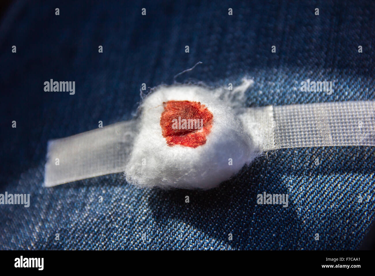 Alcol di cotone chiuso sul braccio dopo la donazione di sangue Foto Stock