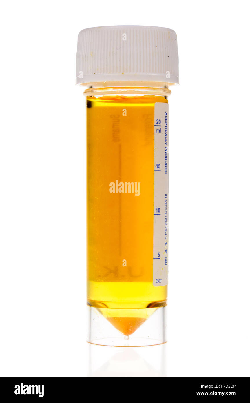 Urine scure in un chiaro, plastica flacone per campione Foto Stock
