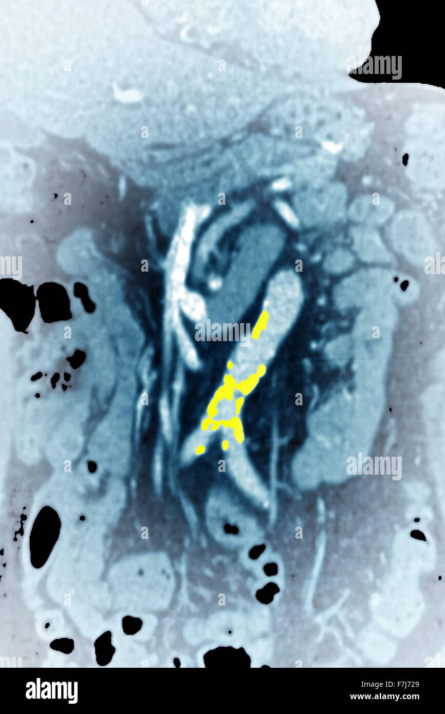 Stenosi dell'aorta addominale immagini e fotografie stock ad alta