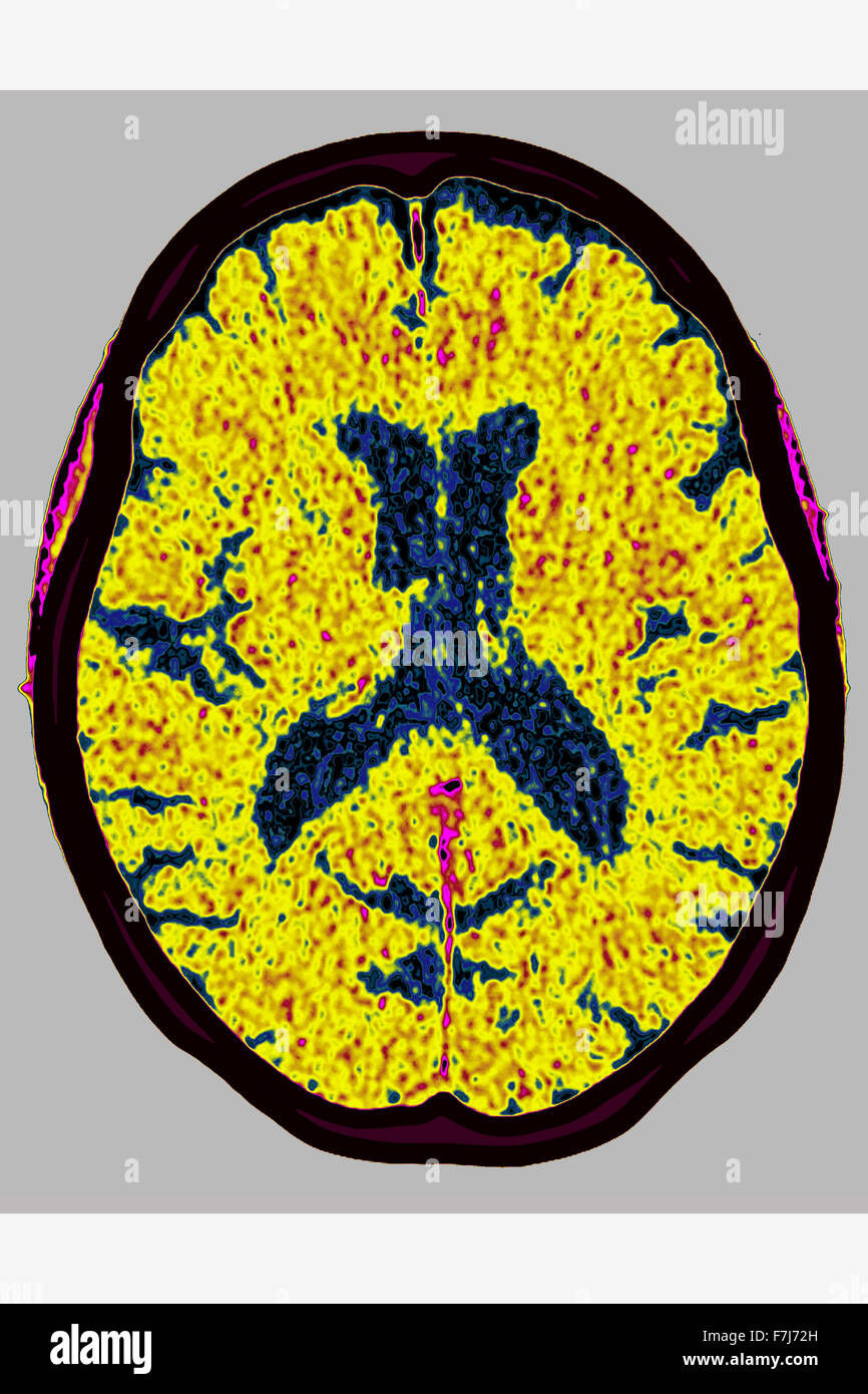 Atrofia cerebrale, la scansione TC Foto Stock