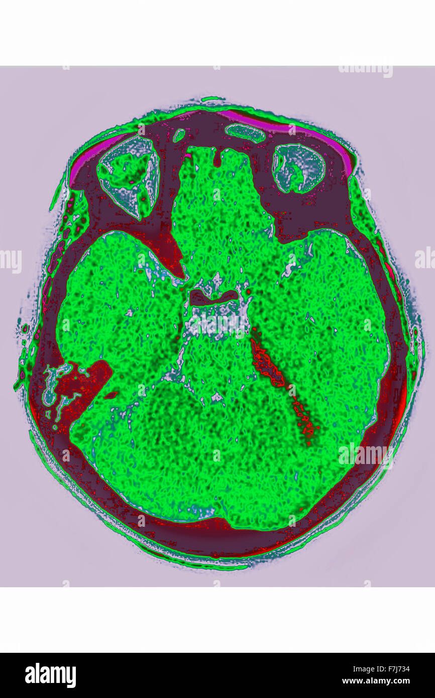 Emorragia, scansione cerebrale Foto Stock