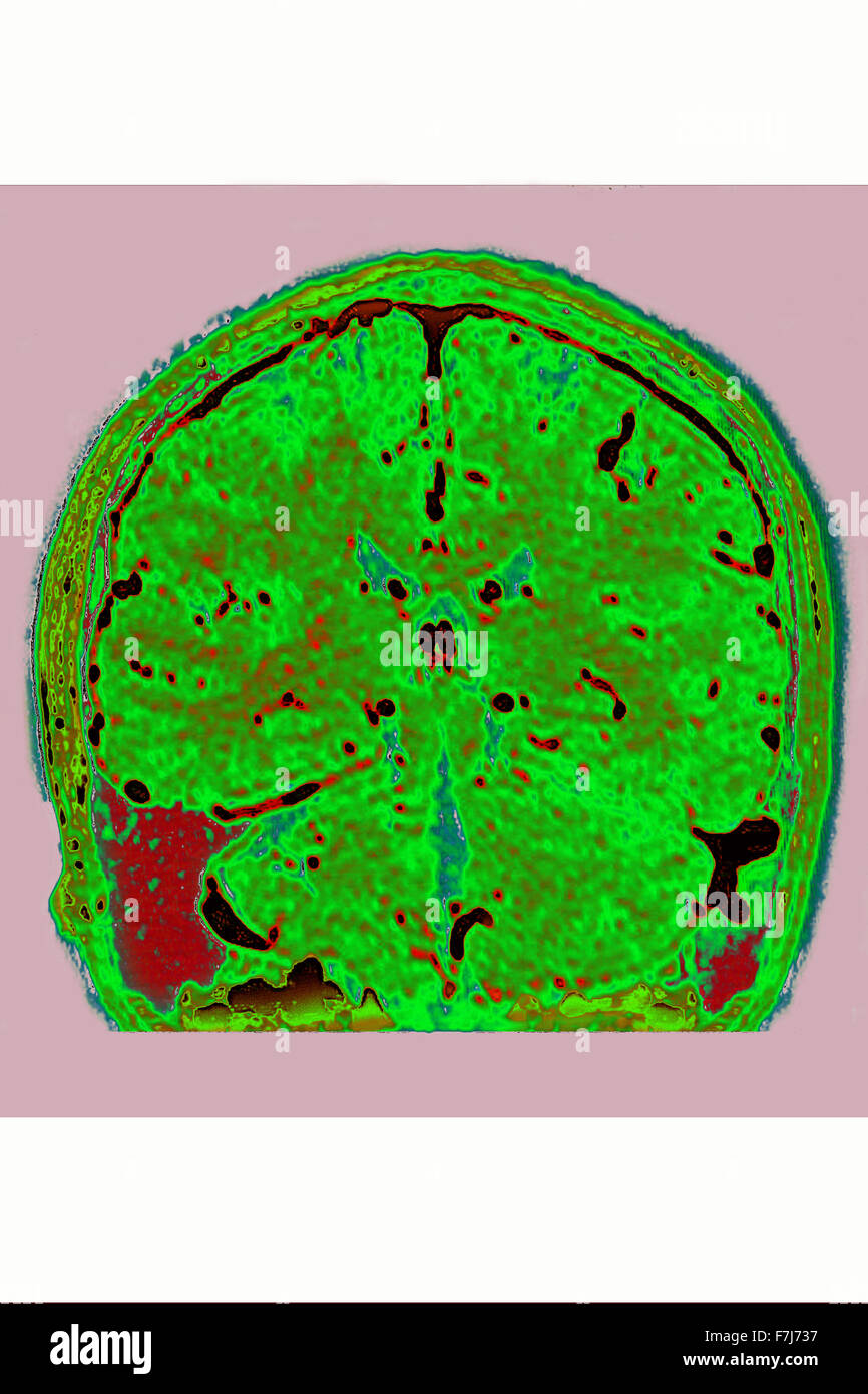 Emorragia, risonanza magnetica cerebrale Foto Stock