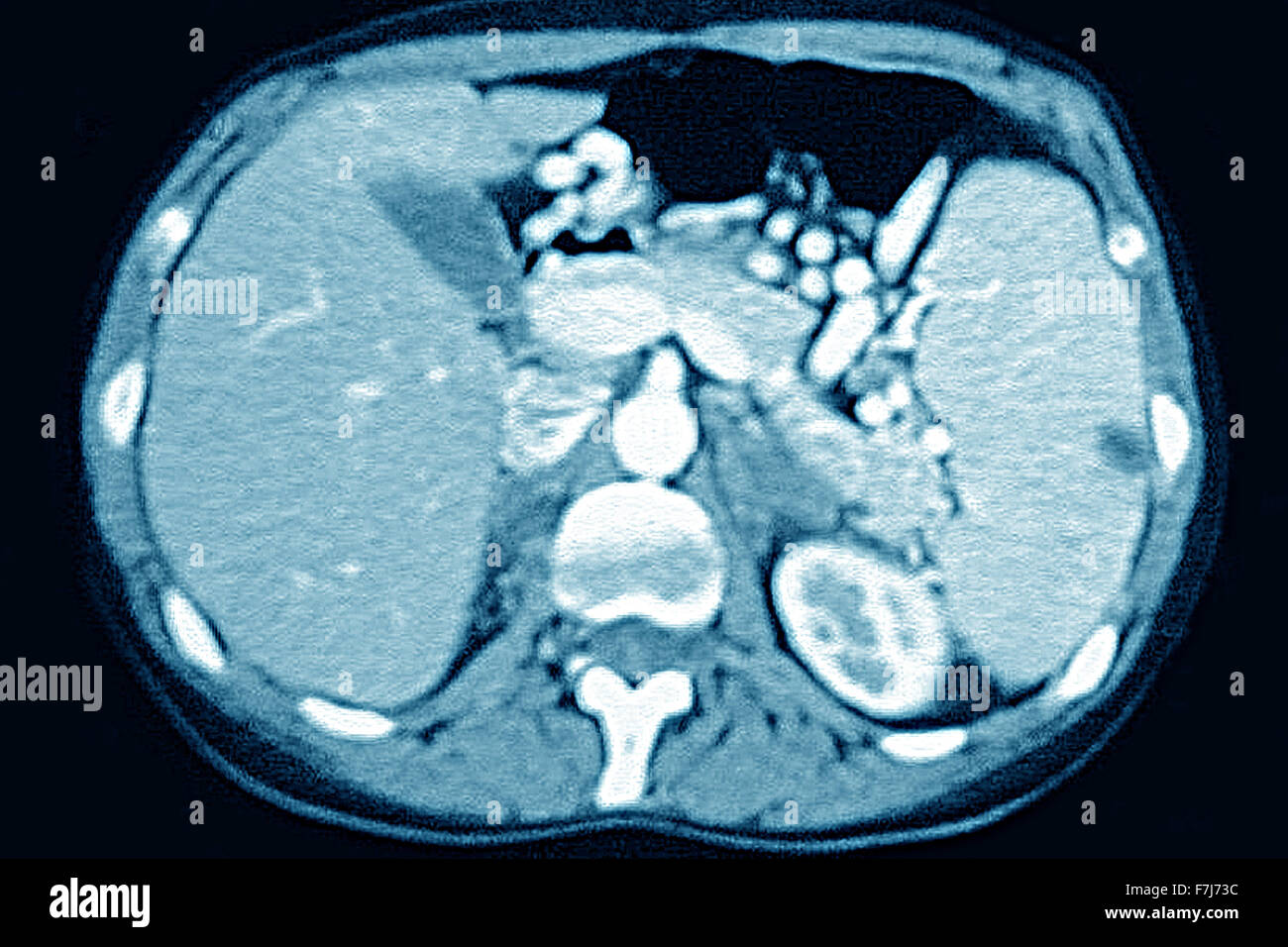 La milza miocardico CT SCAN Foto Stock
