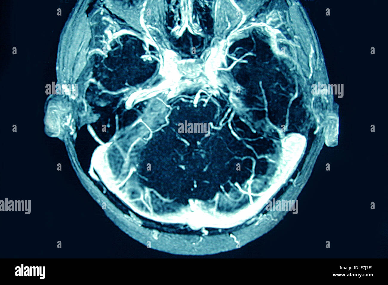 Cerebrale trombosi venosa Foto Stock