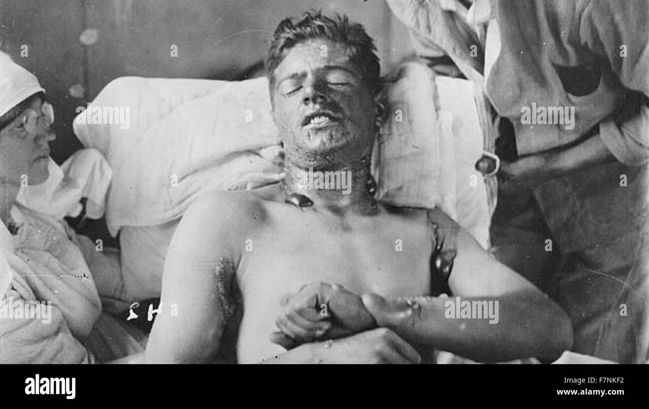 La Prima guerra mondiale, soldato canadese in un ospedale da campo con gas mostarda ustioni. 1915 Foto Stock