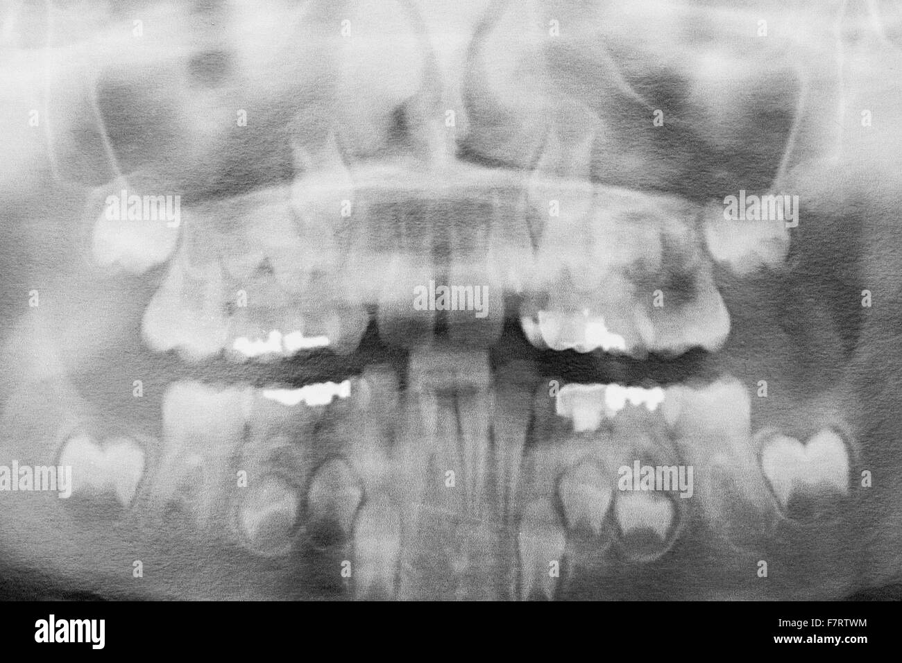 Bambini Panoramica denti umani odontoiatrici a raggi x. Foto Stock