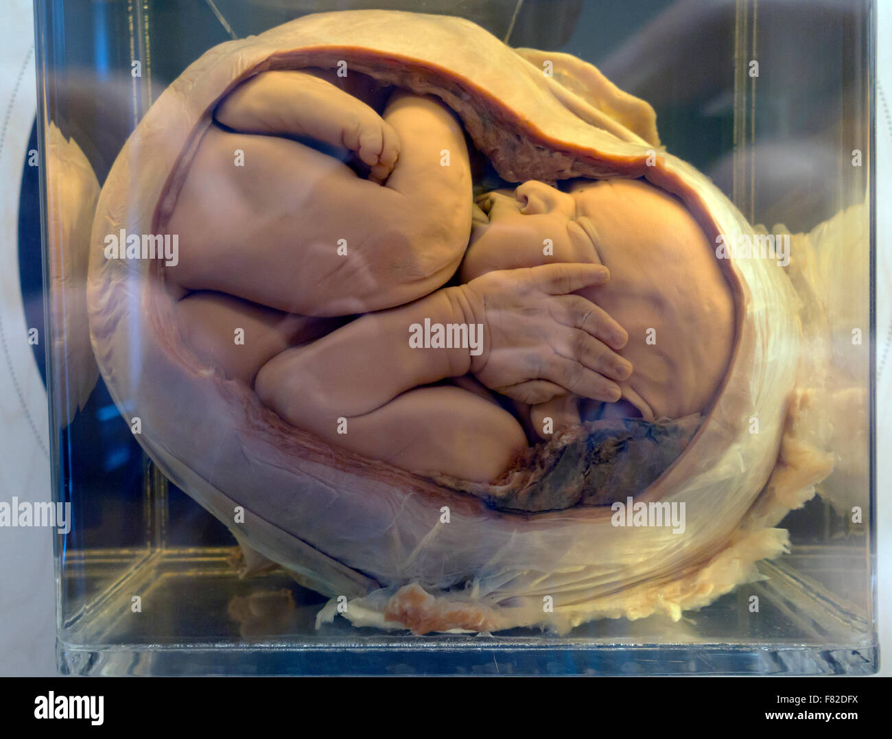 Pienamente sviluppato un feto in utero conservato in formalina jar. Medical Museion, Copenhagen, Danimarca. Foto Stock