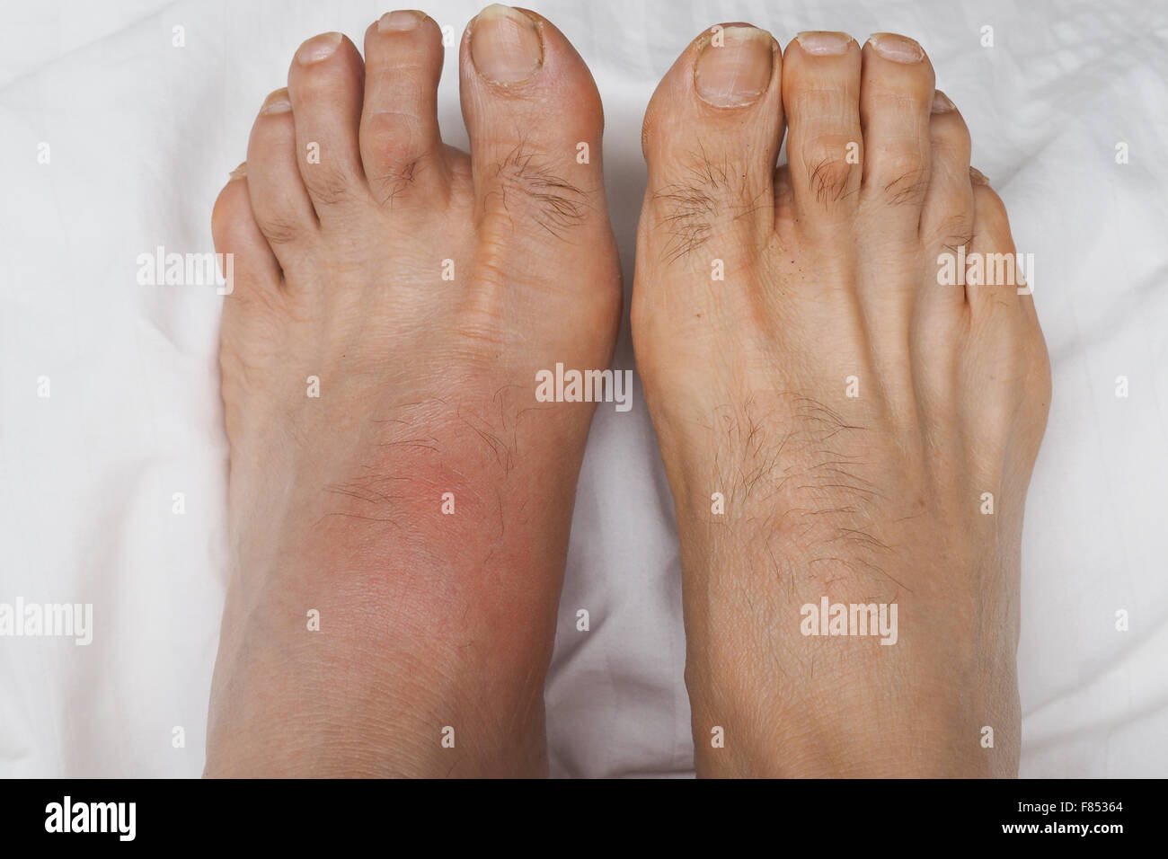 Una coppia di piedi con il piede sinistro infiammato e gonfio di gotta. Foto Stock