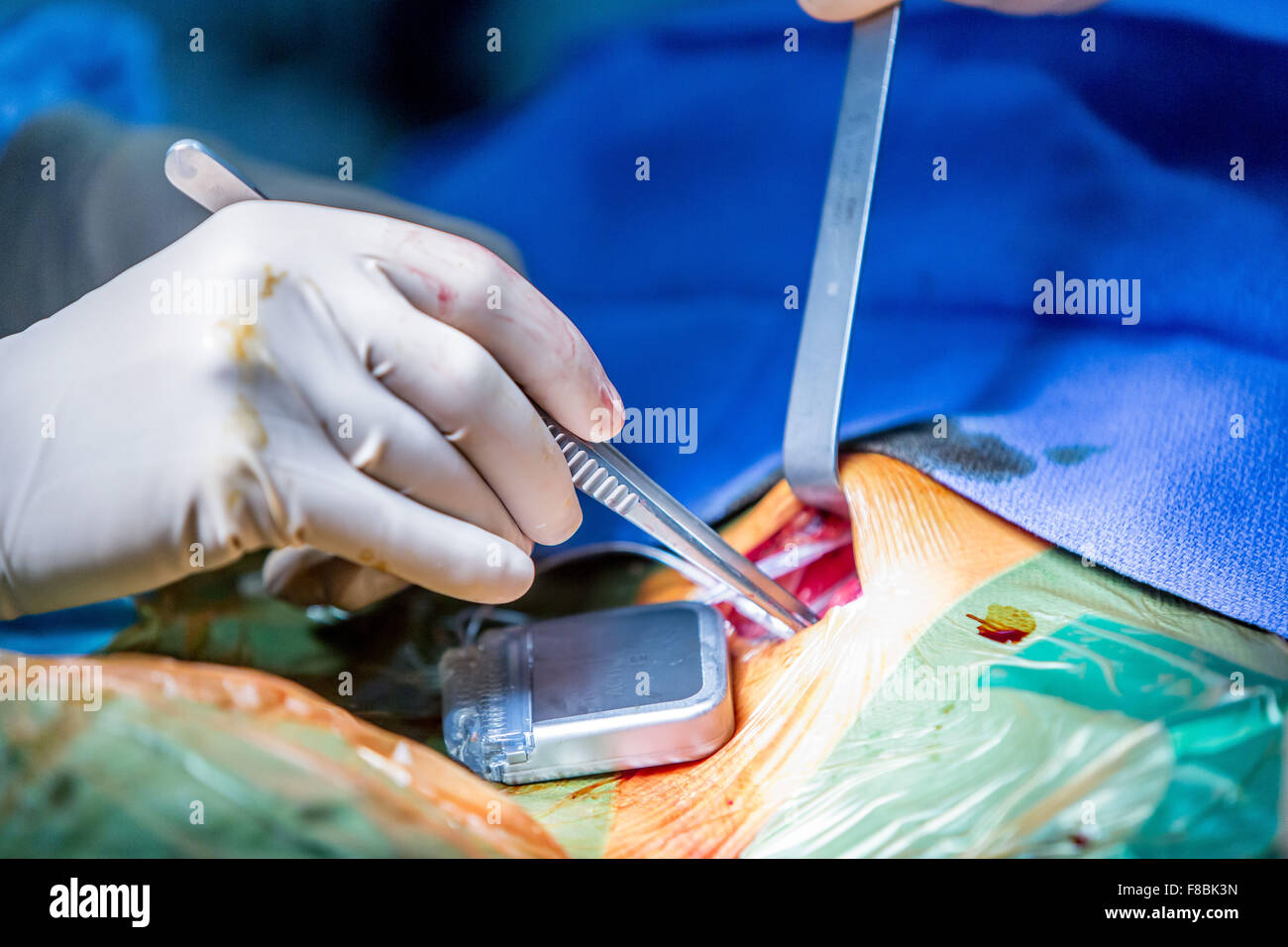 Il trattamento chirurgico del morbo di Parkinson da profonda stimolazione cerebrale con Rosa ® robot, ospedale di Amiens, Francia. Foto Stock