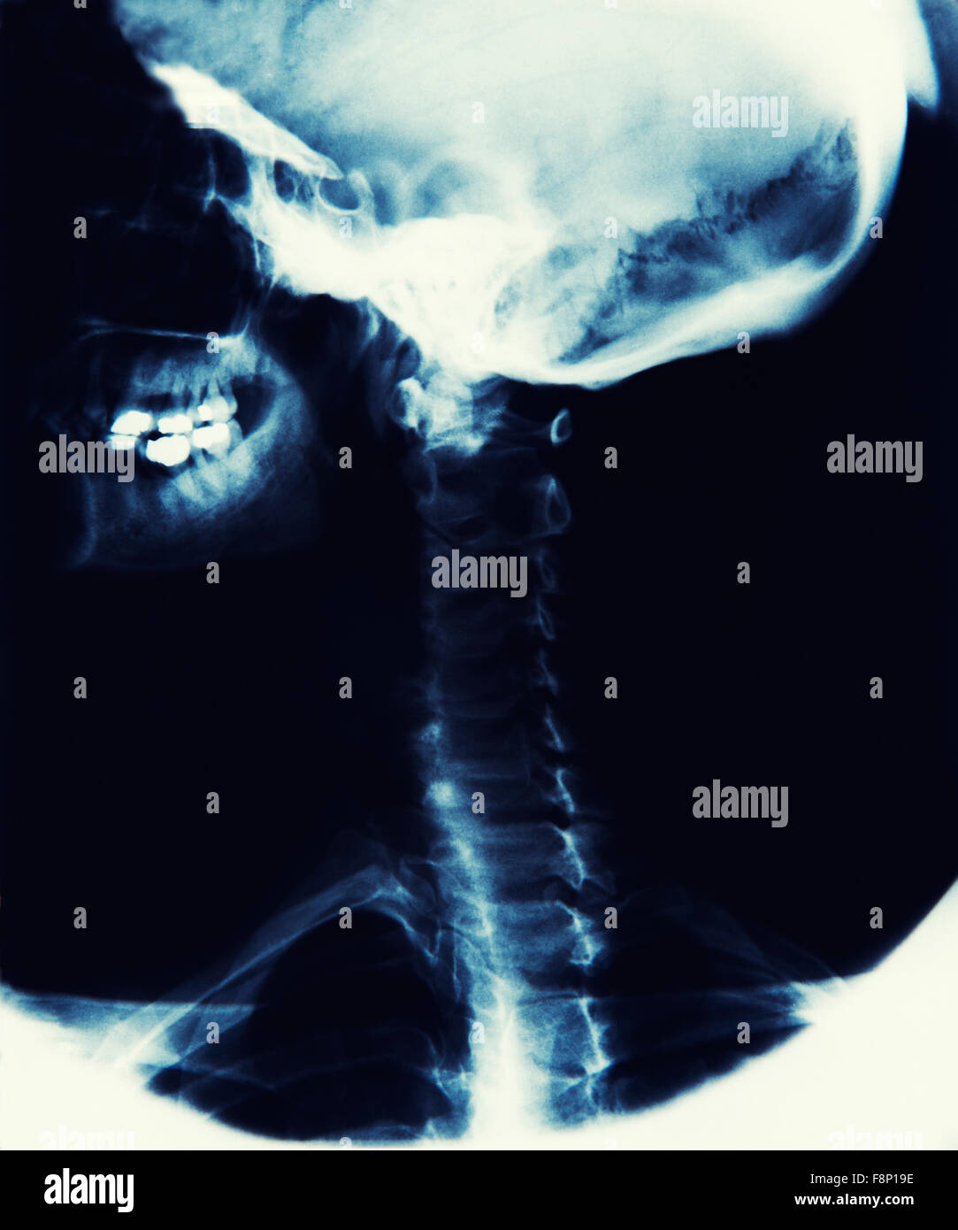 A RAGGI X che mostra immagini cranio, la ganascia e la spina dorsale Foto Stock