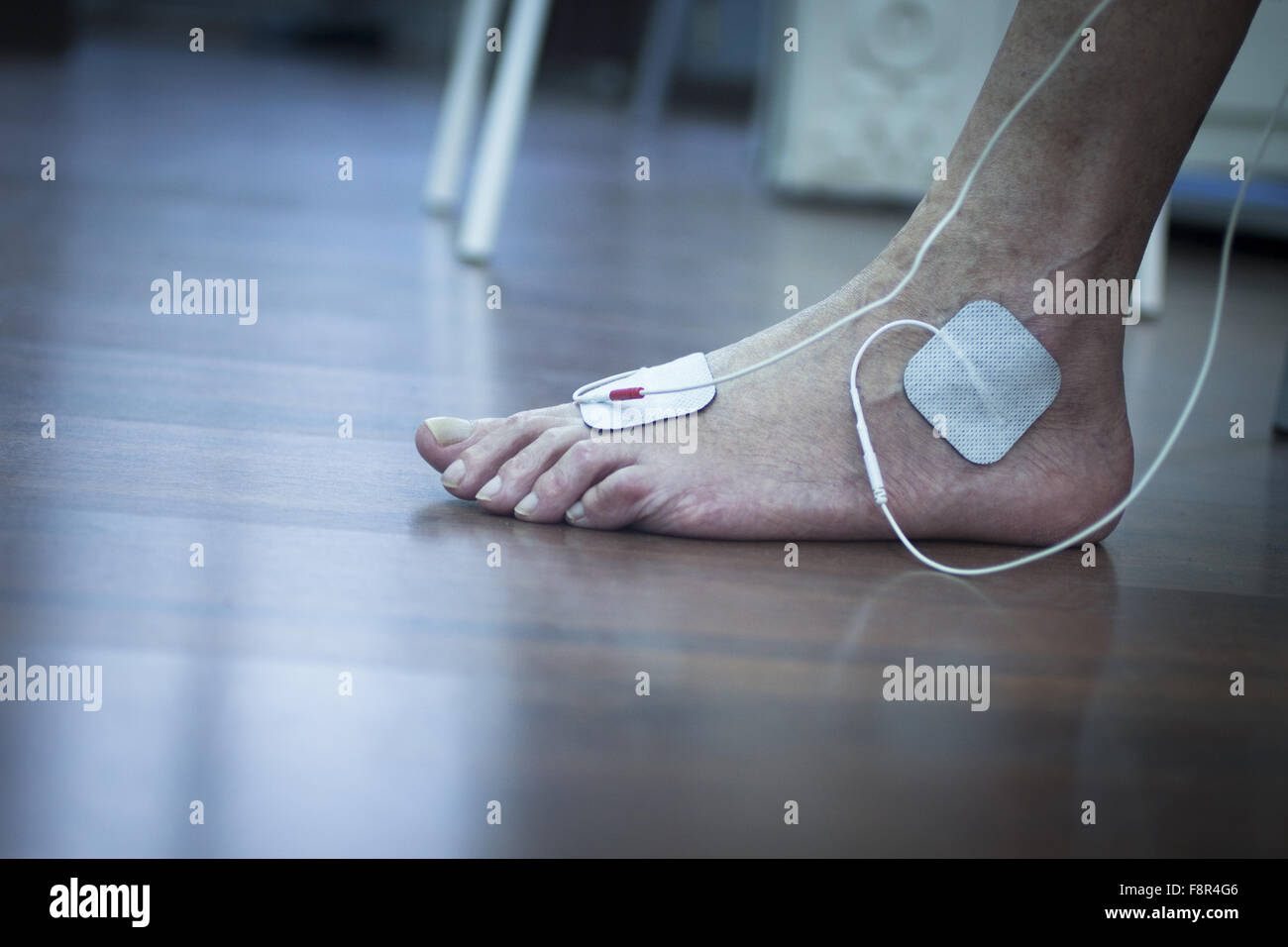 Piede del paziente, gamba e caviglia in elettro fisioterapia impulso  elettrico di stimolazione trattamento di riabilitazione da lesioni in  ospedale con stimolo elettrico collegato con il gesso Foto stock - Alamy