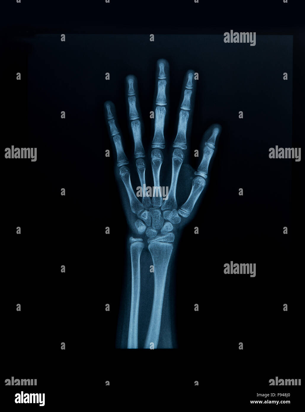 Mano dei raggi x Foto Stock