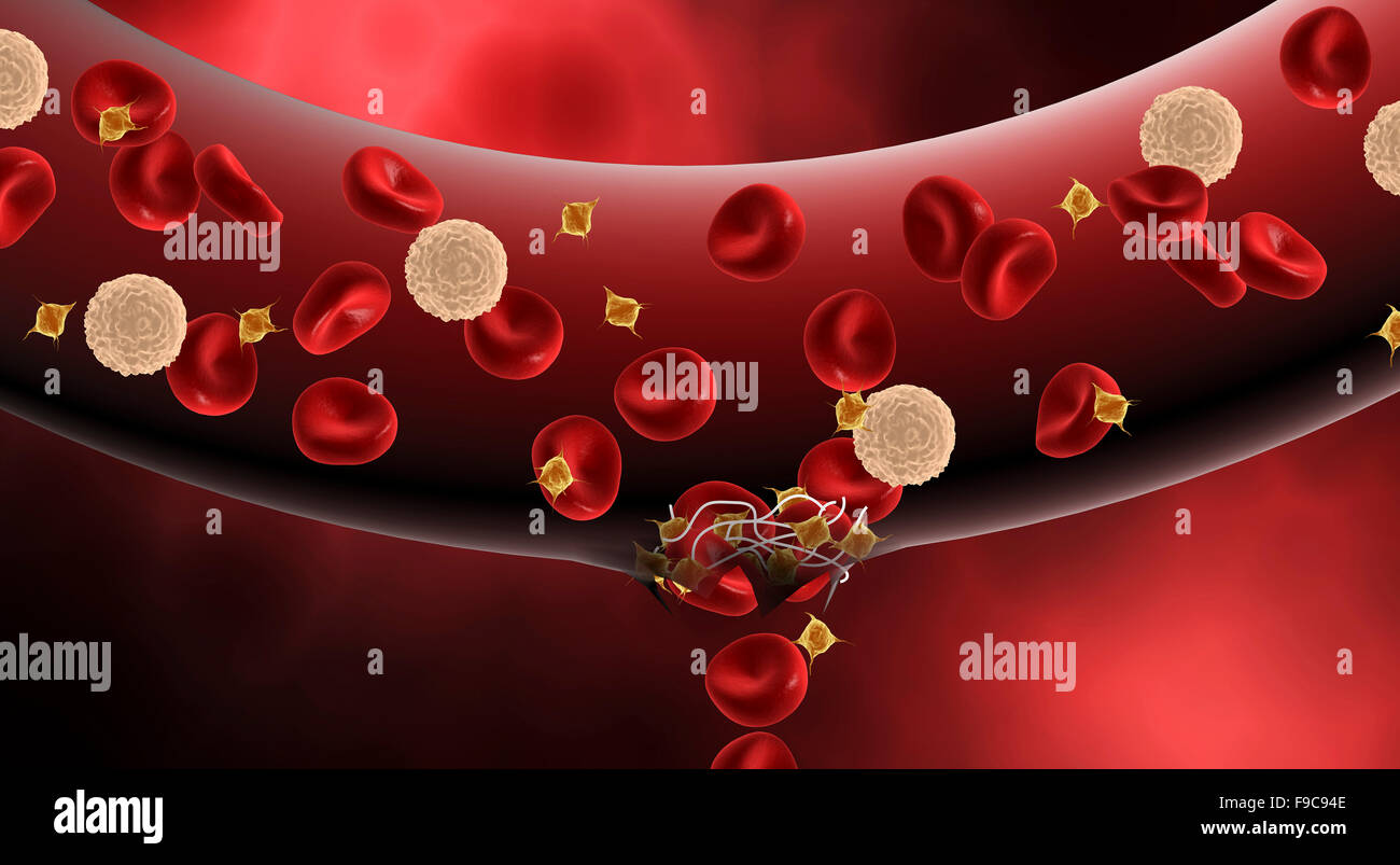 La coagulazione del sangue all'interno di arteria. Foto Stock