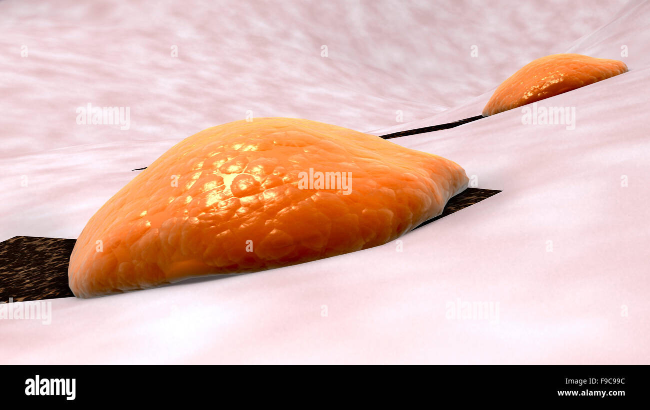Osteoclasti rompendo il tessuto osseo. Foto Stock